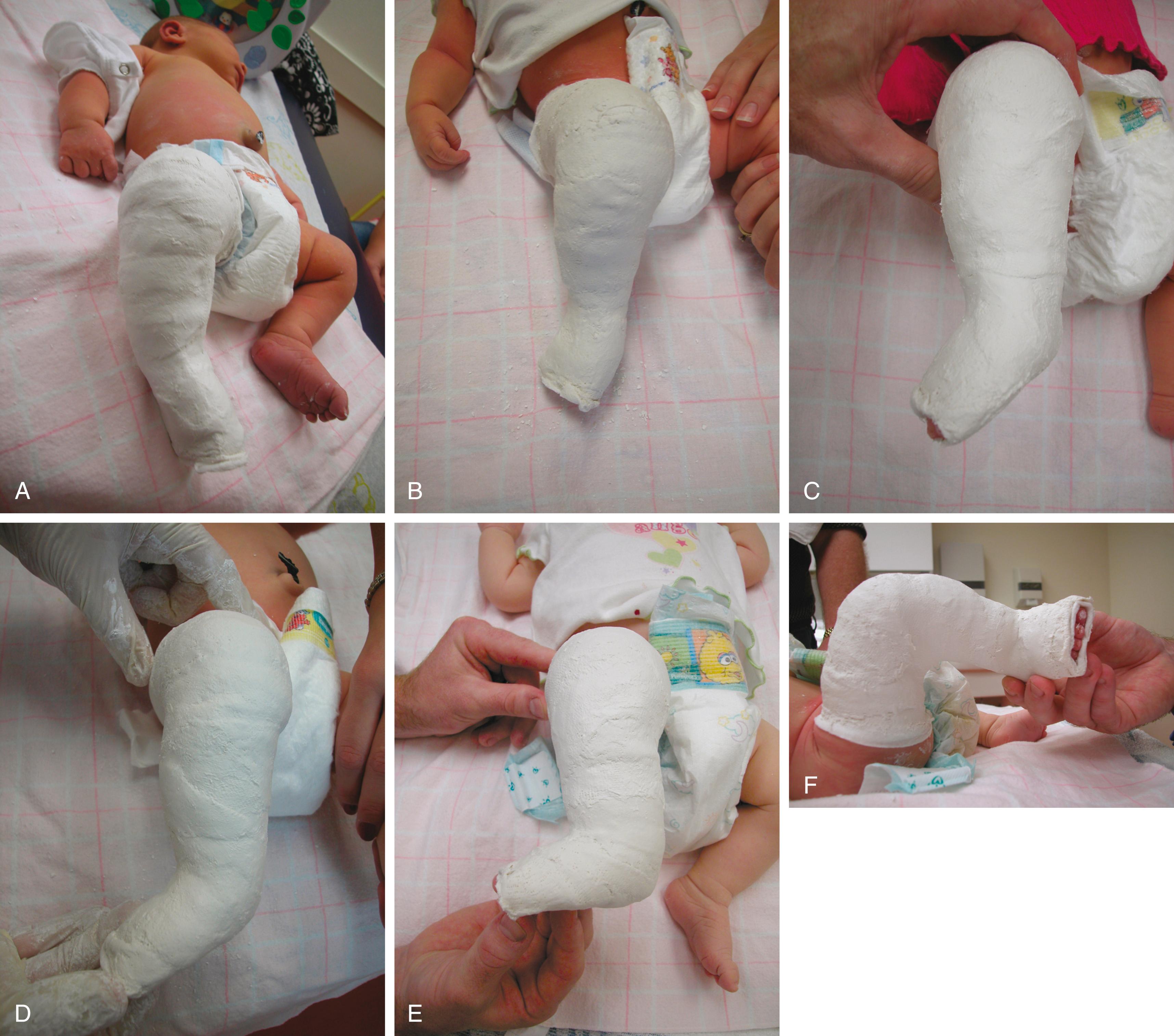 FIG. 19.47, (A–F) Ponseti casts show serial correction of the patient (see Fig. 19.42 ). (E and F) The last cast was applied after percutaneous heel cord tenotomy.