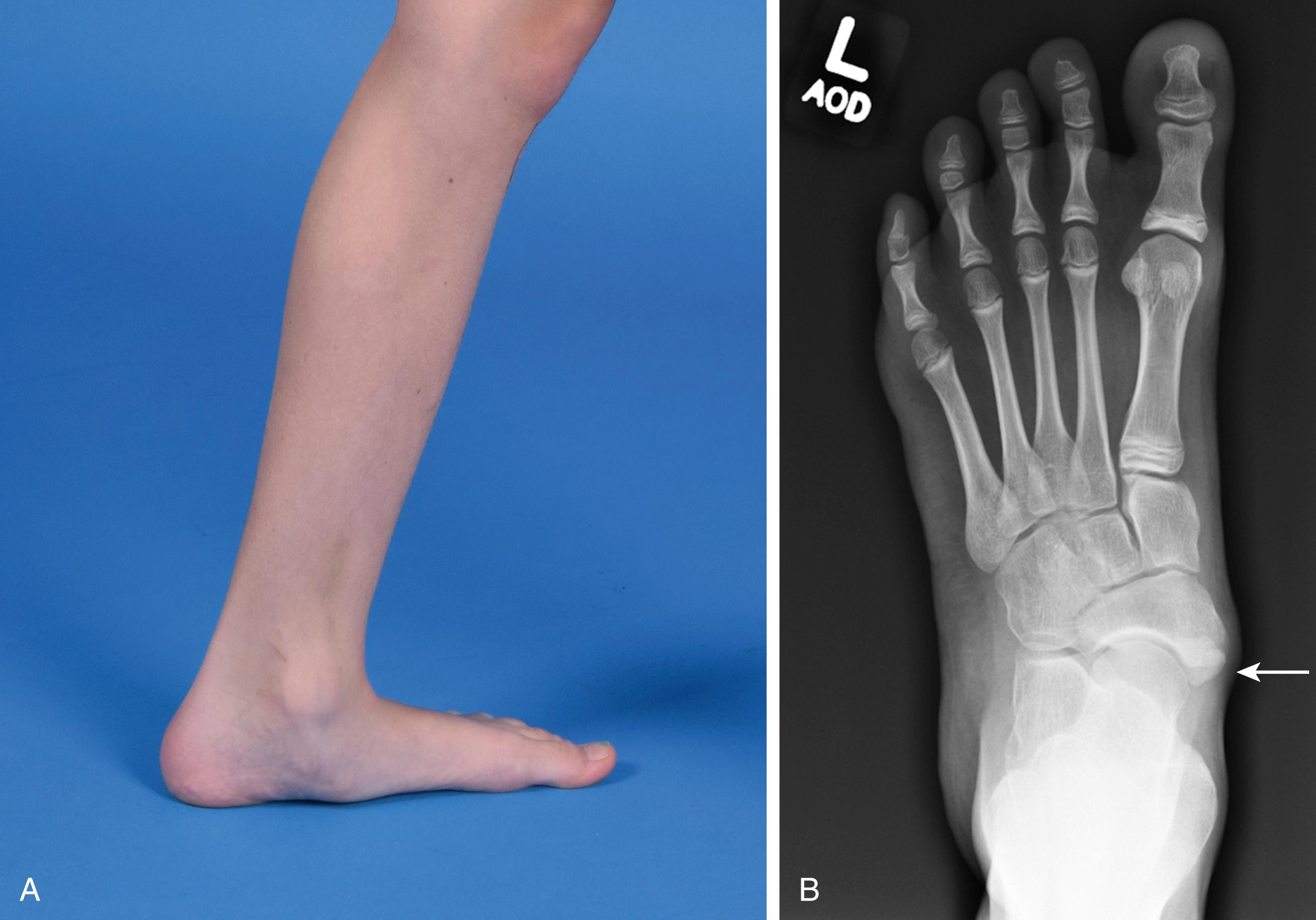 Fig. 19.10, Accessory navicular of the left foot. (A) Clinical appearance. Note the local fullness. (B) Radiographic anteroposterior appearance. Note the smooth and rounded outline of the accessory ossicle (arrow) .