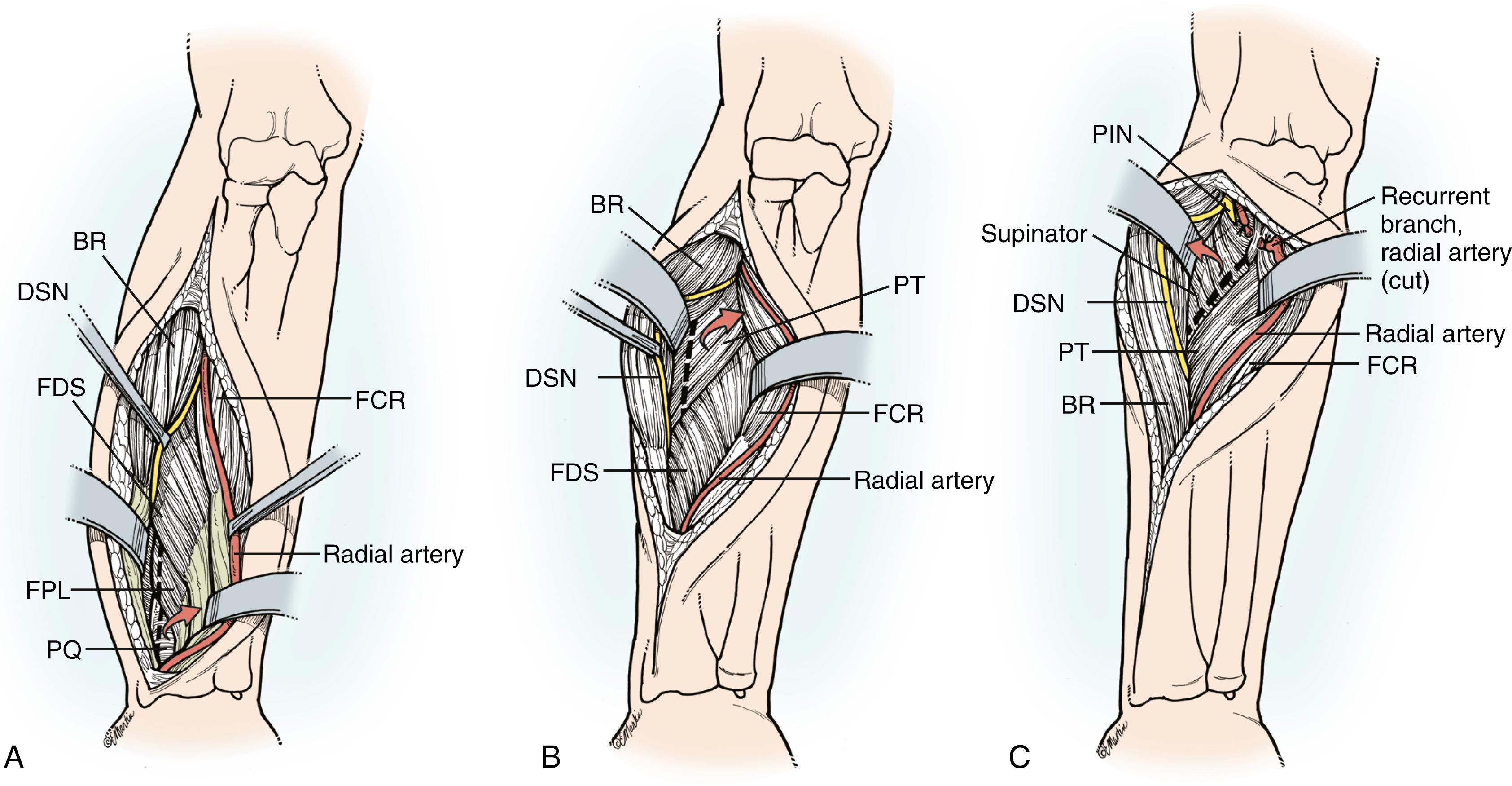 Fig. 21.11, A to C, Deep dissection for the anterior approach to the radial shaft. BR, Brachioradialis; DSN , dorsoradial sensory nerve; FCR, flexor carpi radialis; FDS, flexor digitorum superficialis; FPL, flexor pollicis longus; PIN, posterior interosseous nerve; PQ, pronator quadratus; PT, pronator teres.