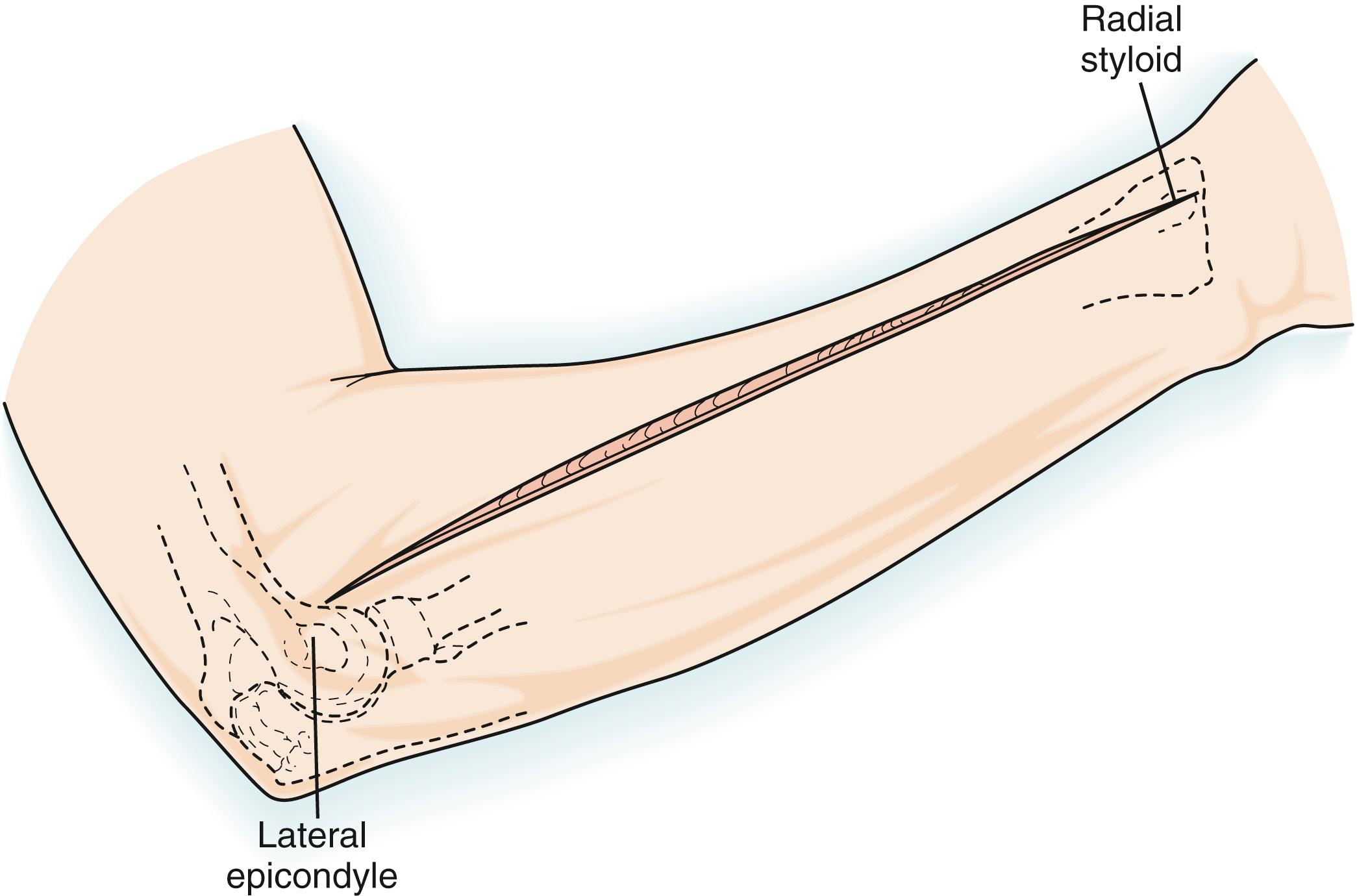 Fig. 21.12, Incision for the posterior approach to the radial shaft. The length of incision is varied according to exposure needs.