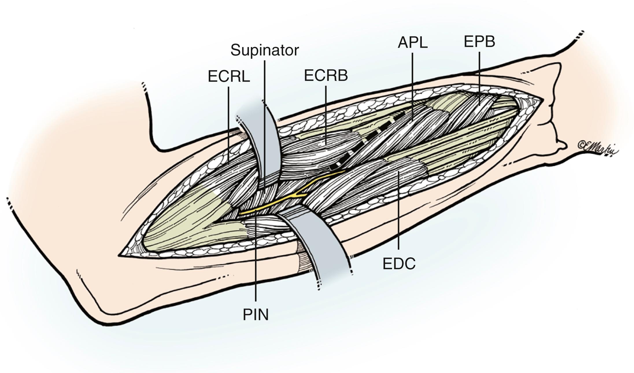 Fig. 21.13, Superficial muscular intervals for the Thompson posterior approach to the radial shaft. APL, Abductor pollicis longus; ECRB, extensor carpi radialis brevis; ECRL, extensor carpi radialis longus; EDC, extensor digitorum communis; EPB, extensor pollicis brevis; PIN, posterior interosseous nerve.