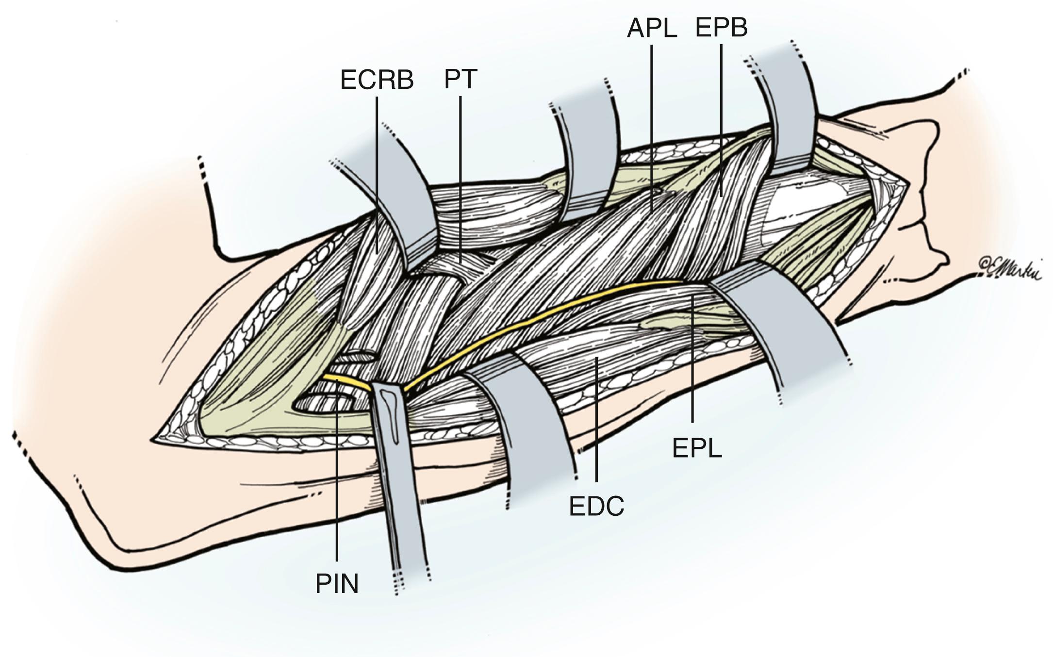 Fig. 21.14, Distal interval. APL, Abductor pollicis longus; ECRB, extensor carpi radialis brevis; EDC, extensor digitorum communis; EPB, extensor pollicis brevis; EPL, extensor pollicis longus; PIN, posterior interosseous nerve; PT, pronator teres.