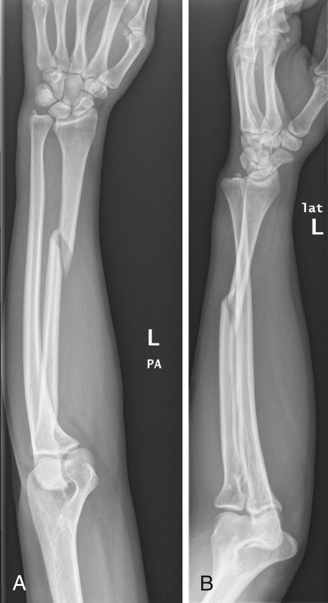 Fig. 21.15, A and B, Radiographs of a Galeazzi fracture-dislocation.