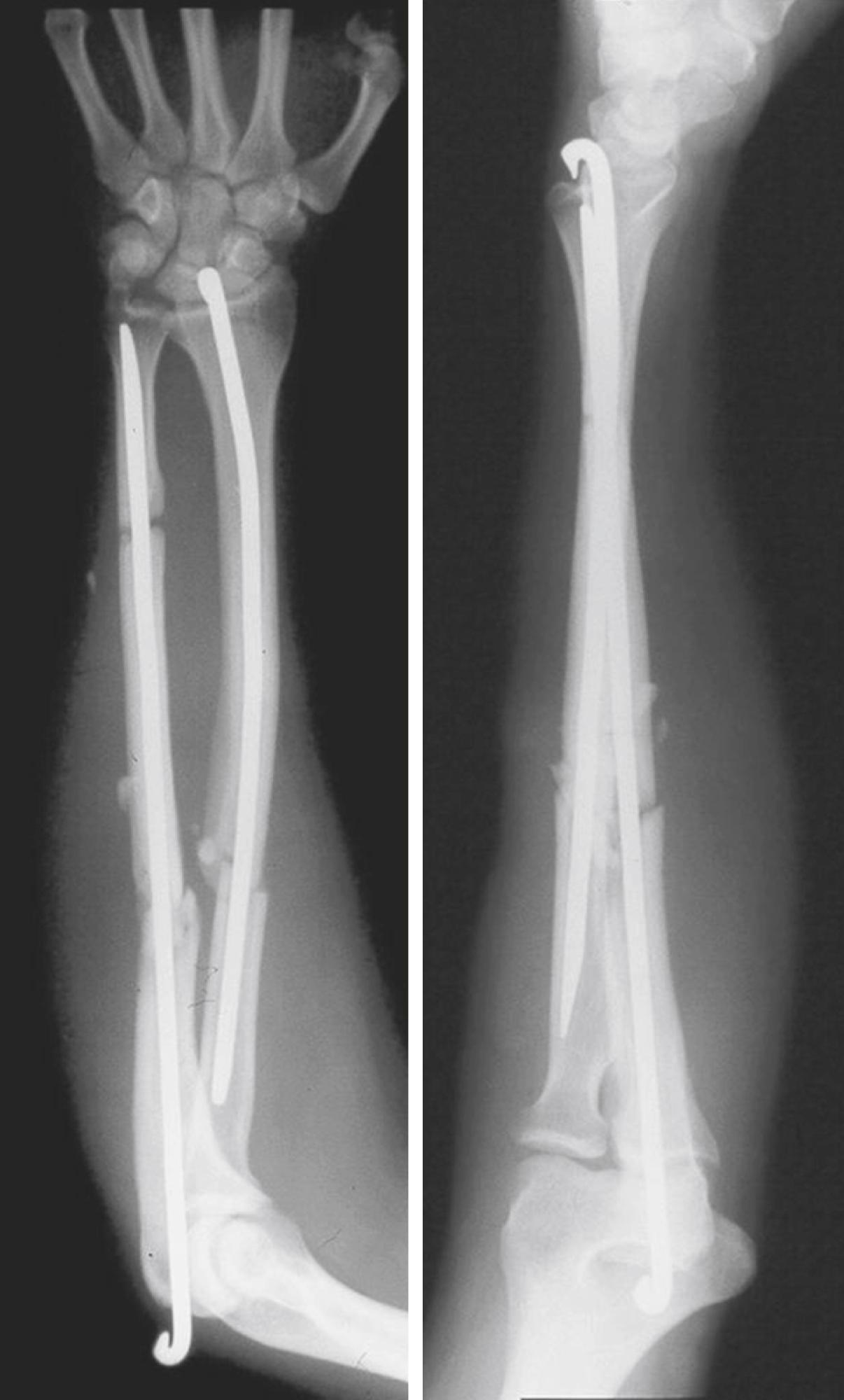 Fig. 21.17, Intramedullary fixation of radial shaft and segmental ulnar shaft fractures associated with significant blunt soft tissue injury.