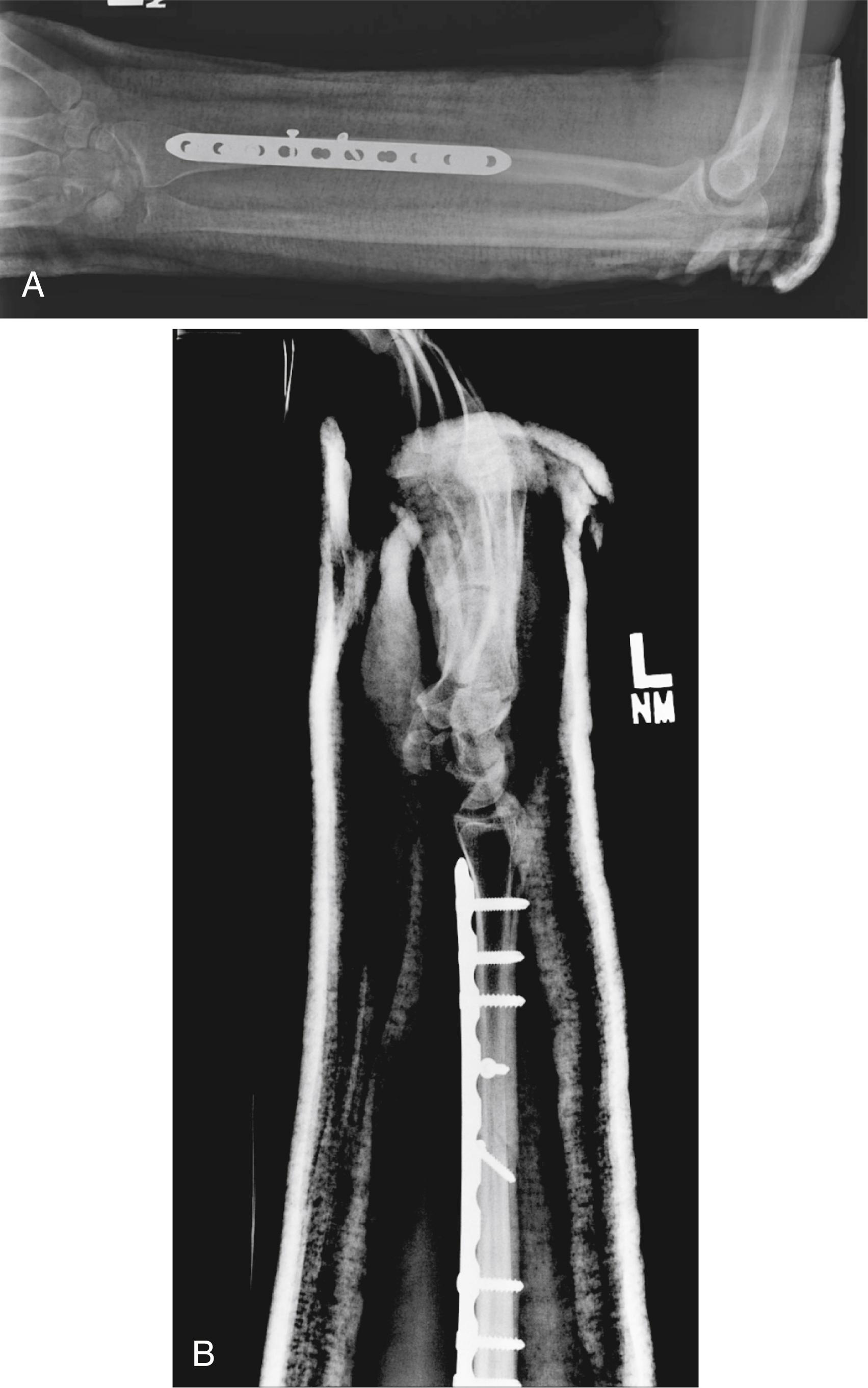 Fig. 21.19, A and B, Posteroanterior and lateral radiographs of the DRUJ after anatomic reduction and fixation of the radial shaft in a Galeazzi fracture-dislocation.