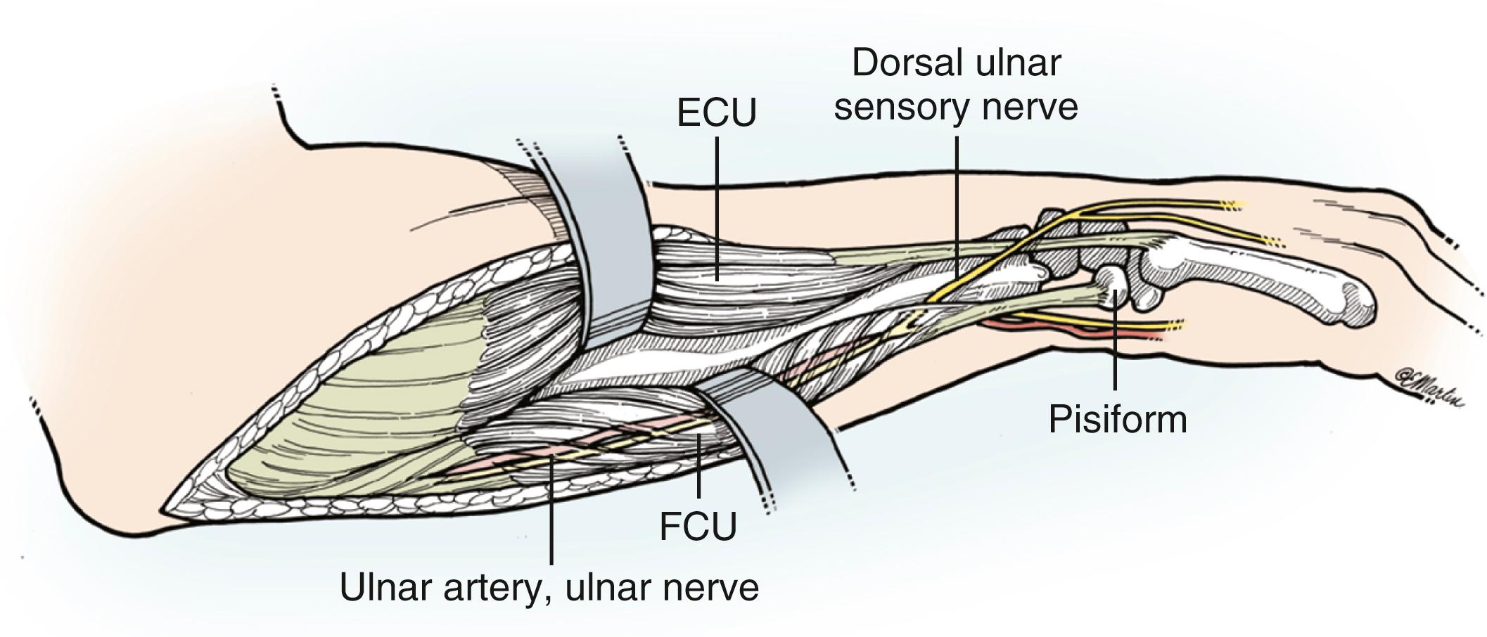 Fig. 21.20, Pertinent anatomy relative to the surgical approach to the ulna. Note the proximity of the ulnar neurovascular structures to the incision and deep dissection and, in particular, the course of the ulnar sensory nerve through the “ulnar snuffbox.” ECU, Extensor carpi ulnaris; FCU, flexor carpi ulnaris.