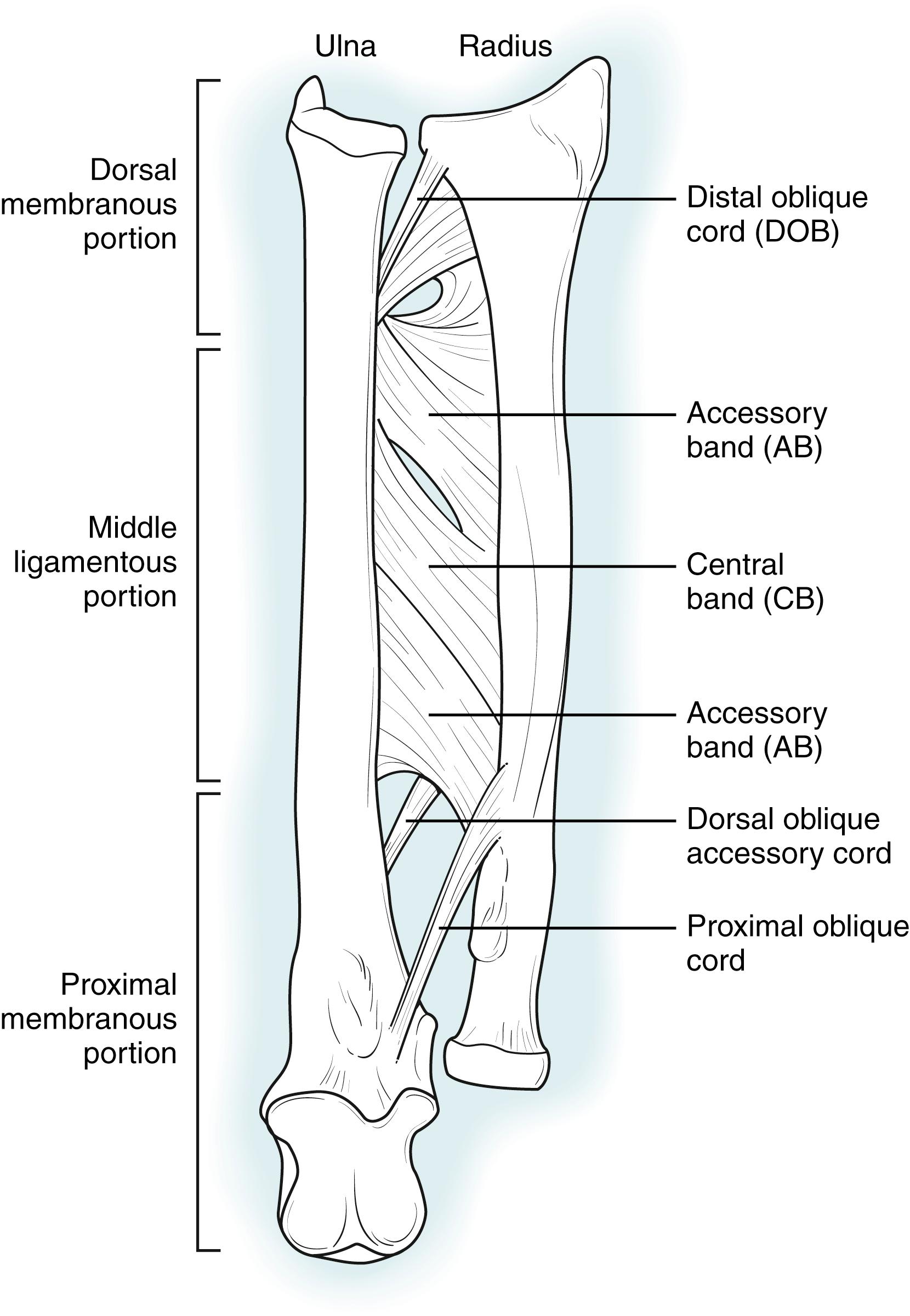 Fig. 21.2, Diagram of the interosseous membrane (right forearm, anterior aspect). Key features include the distal oblique cord (DOB) that lies within the distal membranous portion and the proximal oblique cord that lies on the anterior surface proximally. The middle ligamentous complex contains the central band (CB) and accessory bands (AB).