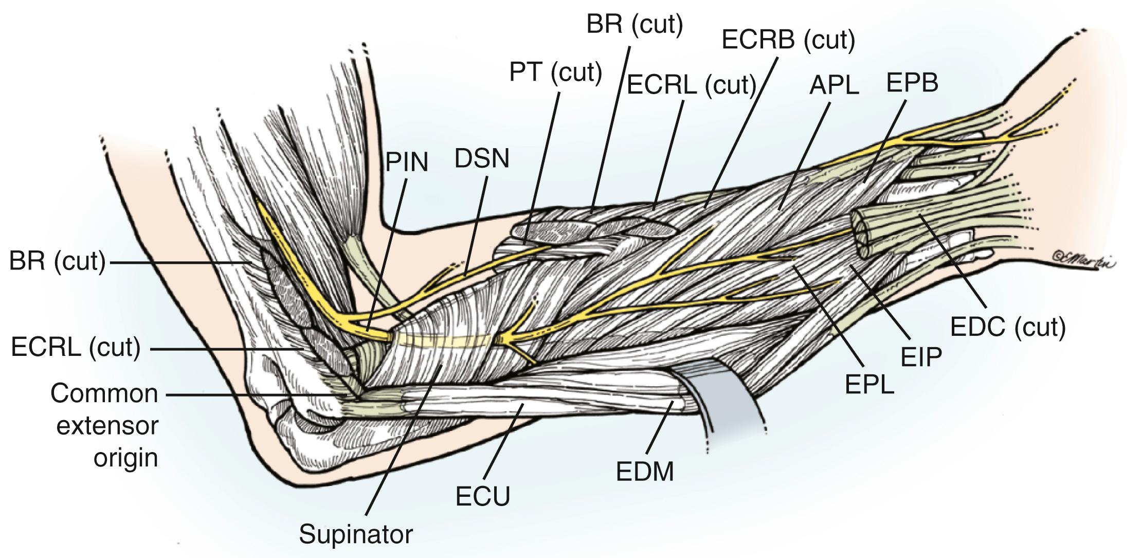 Fig. 21.3, Anatomic relationships of the posterior interosseous and superficial sensory branches of the radial nerve in the forearm. APL, Abductor pollicis longus; BR, brachioradialis; DSN , dorsoradial sensory nerve; ECRB, extensor carpi radialis brevis; ECRL, extensor carpi radialis longus; ECU, extensor carpi ulnaris; EDC, extensor digitorum communis; EDM, extensor digiti minimi; EIP, extensor indicis proprius; EPB, extensor pollicis brevis; EPL, extensor pollicis longus; PIN, posterior interosseous nerve; PT, pronator teres.