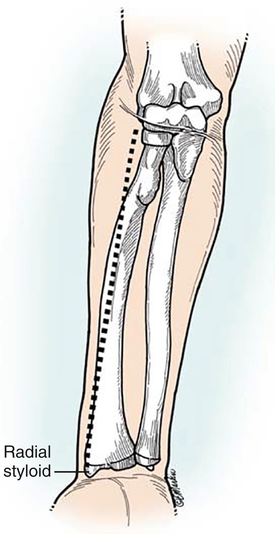 Fig. 21.8, Incision for the anterior approach to the radial shaft. The length of the incision varies depending on exposure requirements.