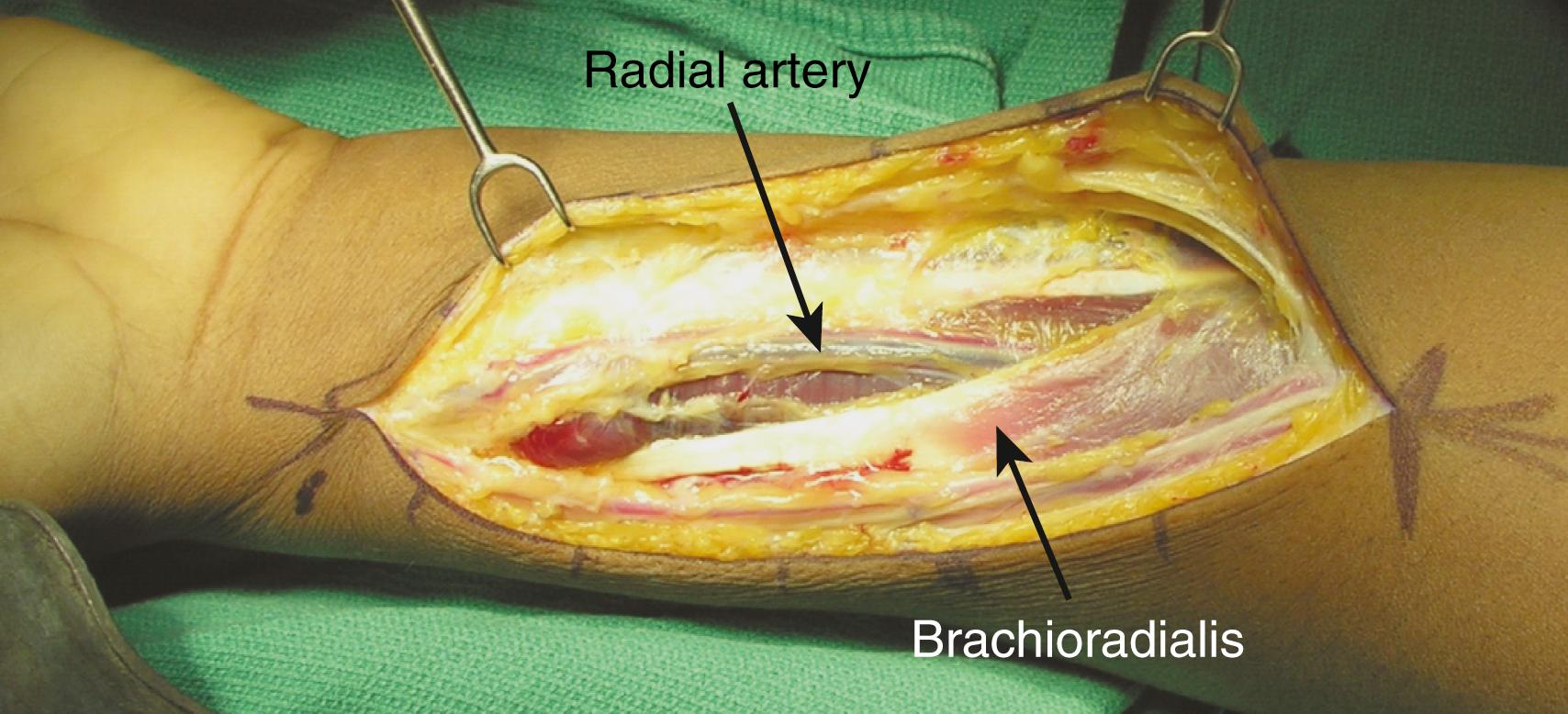 Fig. 21.9, Clinical photograph demonstrating superficial exposure of the anterior approach to the radius and the anatomic relationships of the radial artery.