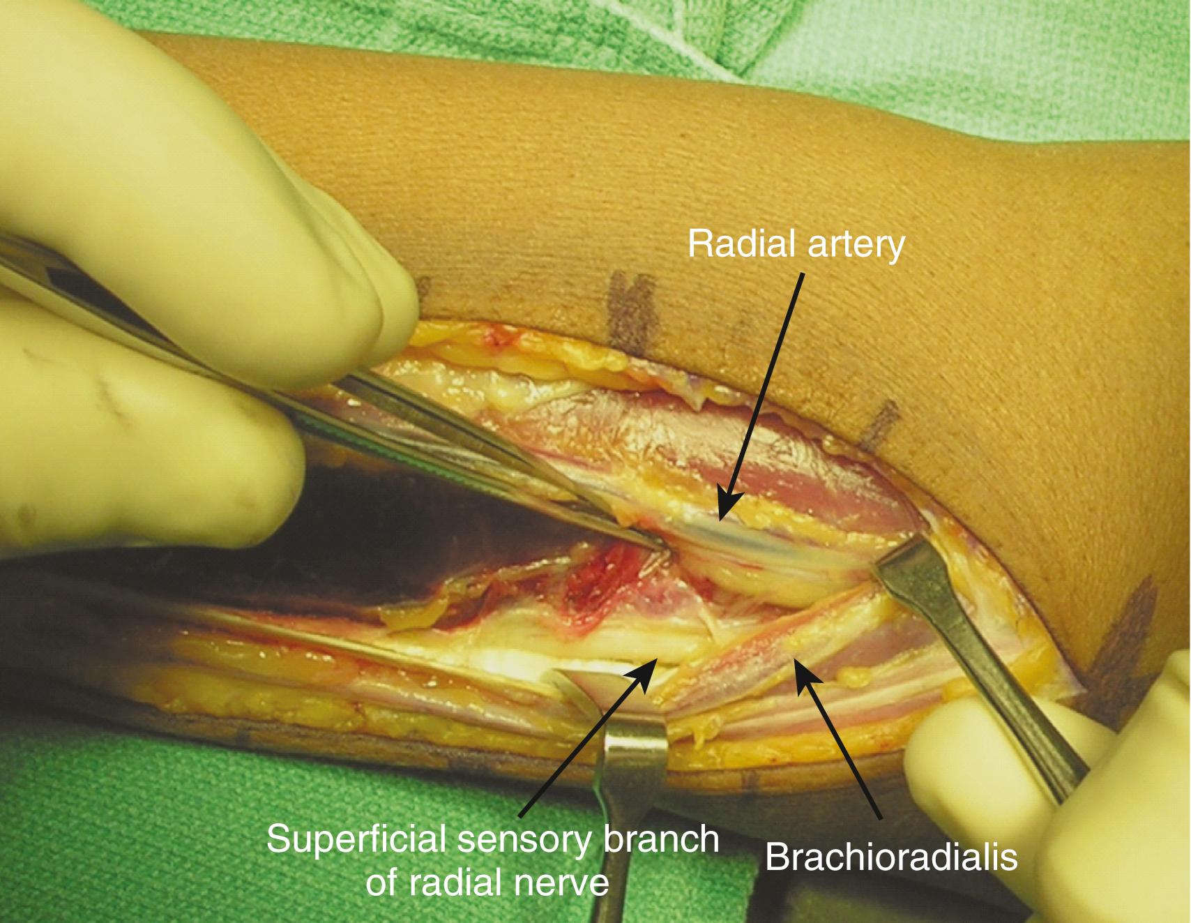 Fig. 21.10, Clinical photograph demonstrating anatomic relationships of the radial artery, brachioradialis, and superficial sensory branch of the radial nerve.