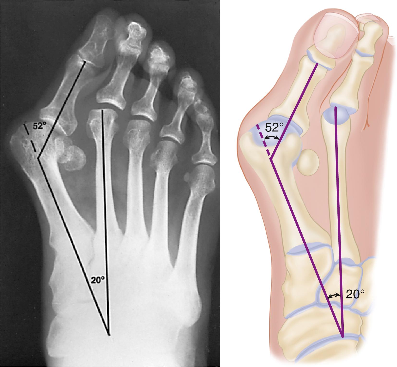 FIGURE 82.1, Hallux valgus complex. Note increase in intermetatarsal angle, lateral dislocation of sesamoids, subluxation of first metatarsophalangeal joint (leaving metatarsal head uncovered), and pronation of great toe associated with marked hallux valgus.