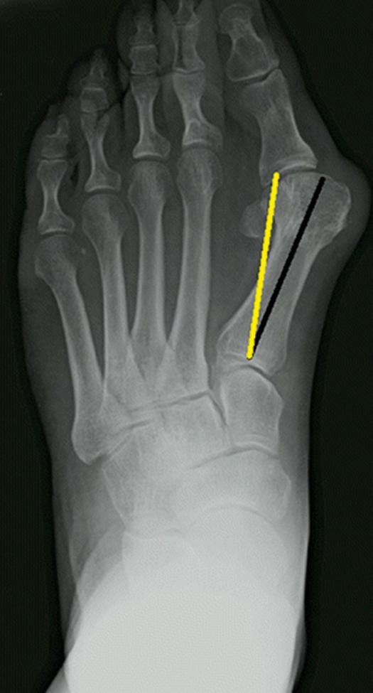 FIGURE 82.11, Angle to be corrected (ATC). Black line (metatarsal bone axis) passes through midline of base of metatarsal head. Yellow line begins at same point as metatarsal bone axis but ends at midpoint of sesamoid complex, mid-distance between medial and lateral sesamoid.