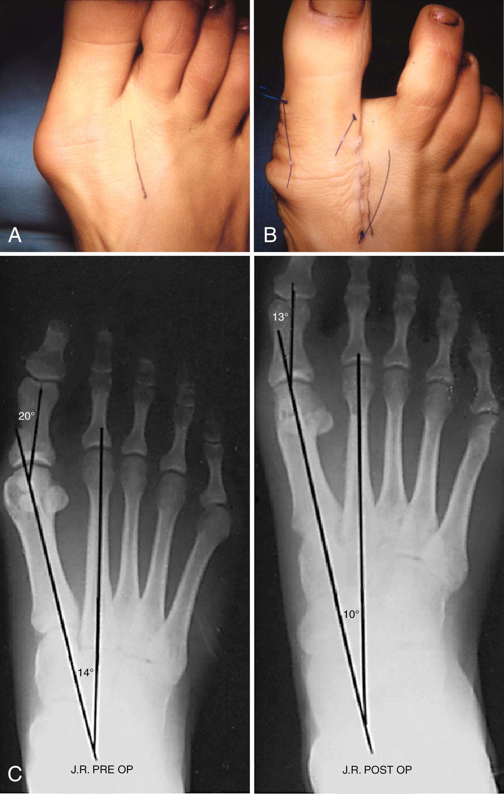 FIGURE 82.12, Hallux valgus treated by modified McBride procedure. A, Preoperative deformity in 30-year-old patient. B, Correction obtained at surgery. C, Preoperative and postoperative radiographs (note fibular sesamoid was not removed). More deformity can be corrected by fibular sesamoidectomy, but overcorrection (hallux varus) is a risk. If fibular sesamoid is excised, medial capsule should be closed while holding hallux in 5 to 10 degrees valgus and kept in that position until capsular healing.