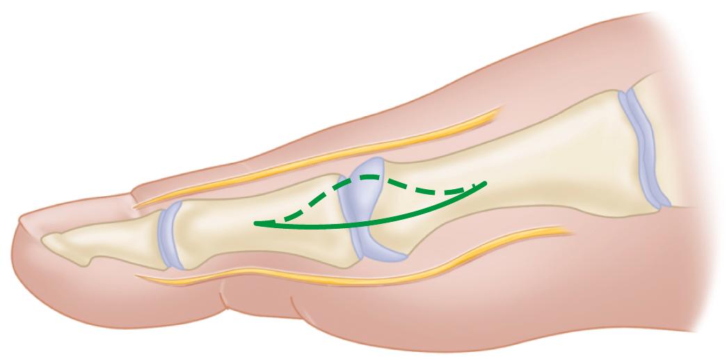 FIGURE 82.13, Modified McBride procedure: first incision. Dashed line denotes dorsally curved incision; solid line indicates preferred incision (internervous plane). SEE TECHNIQUE 82.1.