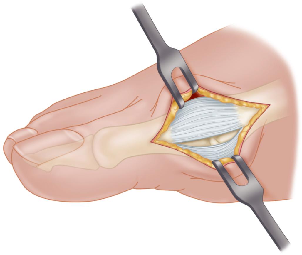 FIGURE 82.14, Modified McBride procedure. Longitudinal capsular incision is 3 to 4 mm plantar to skin incision. SEE TECHNIQUE 82.1.