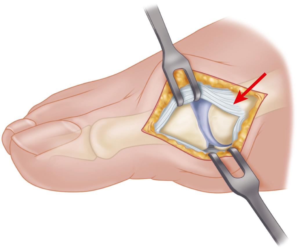 FIGURE 82.15, Modified McBride procedure. Capsule is opened, and attachment of capsule on metatarsal neck (arrow) is carefully preserved. SEE TECHNIQUE 82.1.