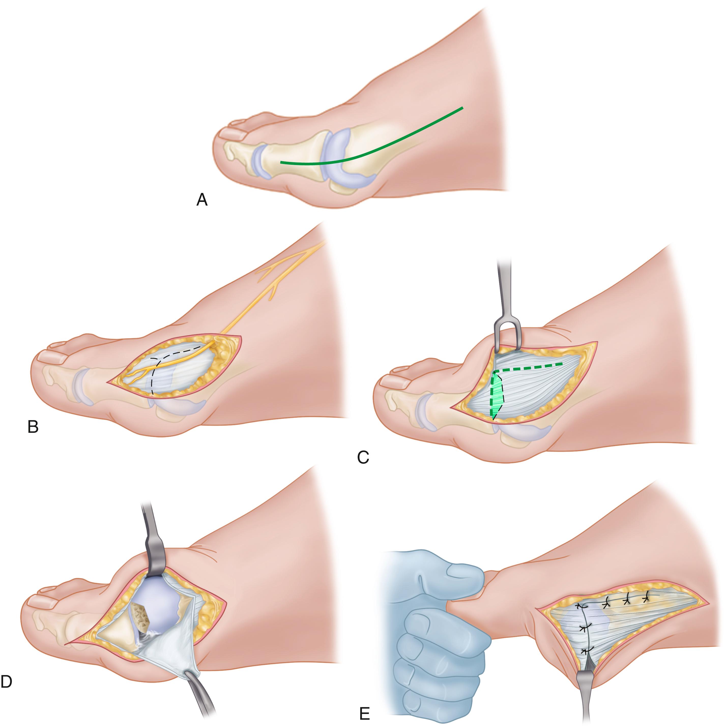 FIGURE 82.16, Inverted-L capsulotomy. A, Skin incision. B, Most medial branch of superficial peroneal nerve. C, Limits of capsulotomy with medial-based wedge. D, Capsule raised to expose articular surface of metatarsal head for assessment of orientation on metatarsal head. E, Closure of L-shaped capsulotomy holding first metatarsophalangeal joint reduced. SEE TECHNIQUE 82.1.