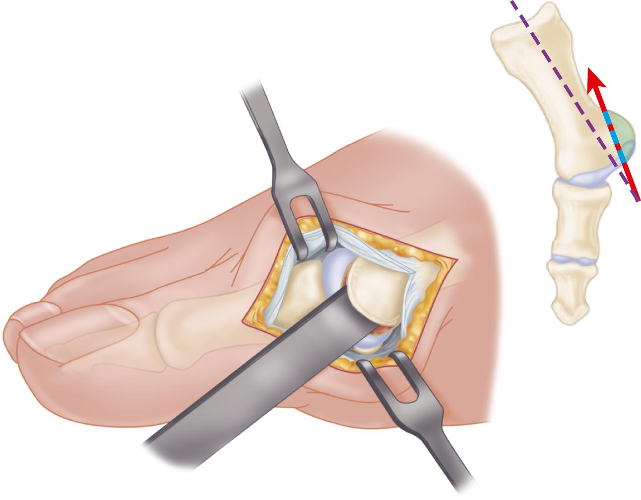 FIGURE 82.17, Modified McBride procedure. Medial eminence is removed. SEE TECHNIQUE 82.1.