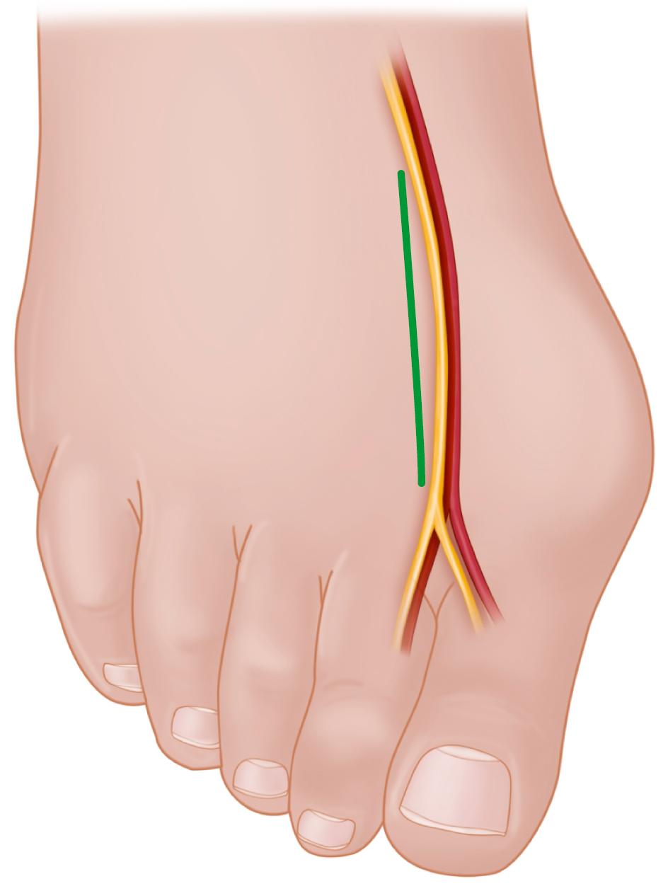 FIGURE 82.18, Modified McBride procedure: second incision. Deep peroneal nerve branch to first web space is avoided, and terminal portion of first dorsal intermetatarsal artery is exposed. SEE TECHNIQUE 82.1.