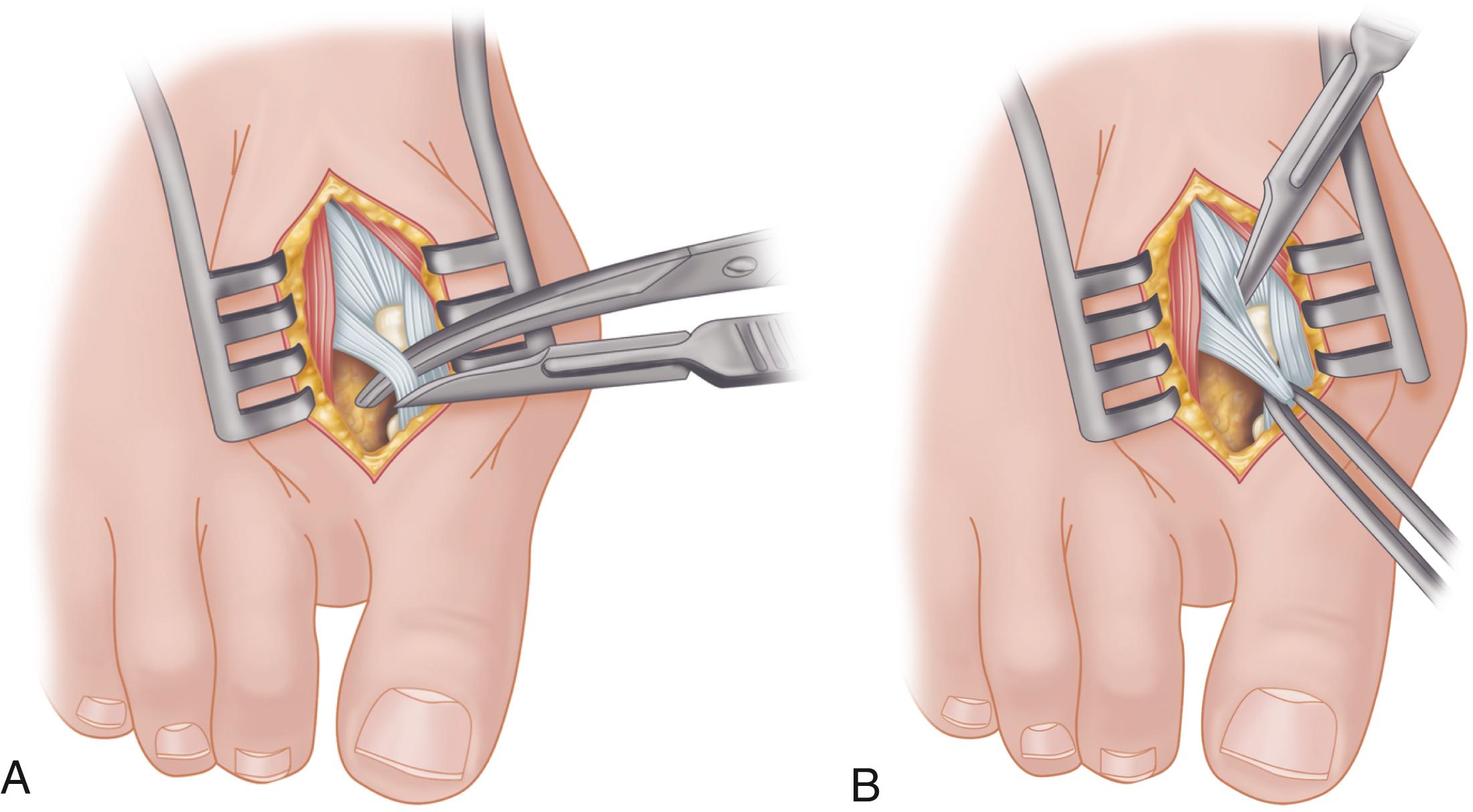 FIGURE 82.19, Modified McBride procedure. A and B, Adductor hallucis is exposed and released (see text). SEE TECHNIQUE 82.1.