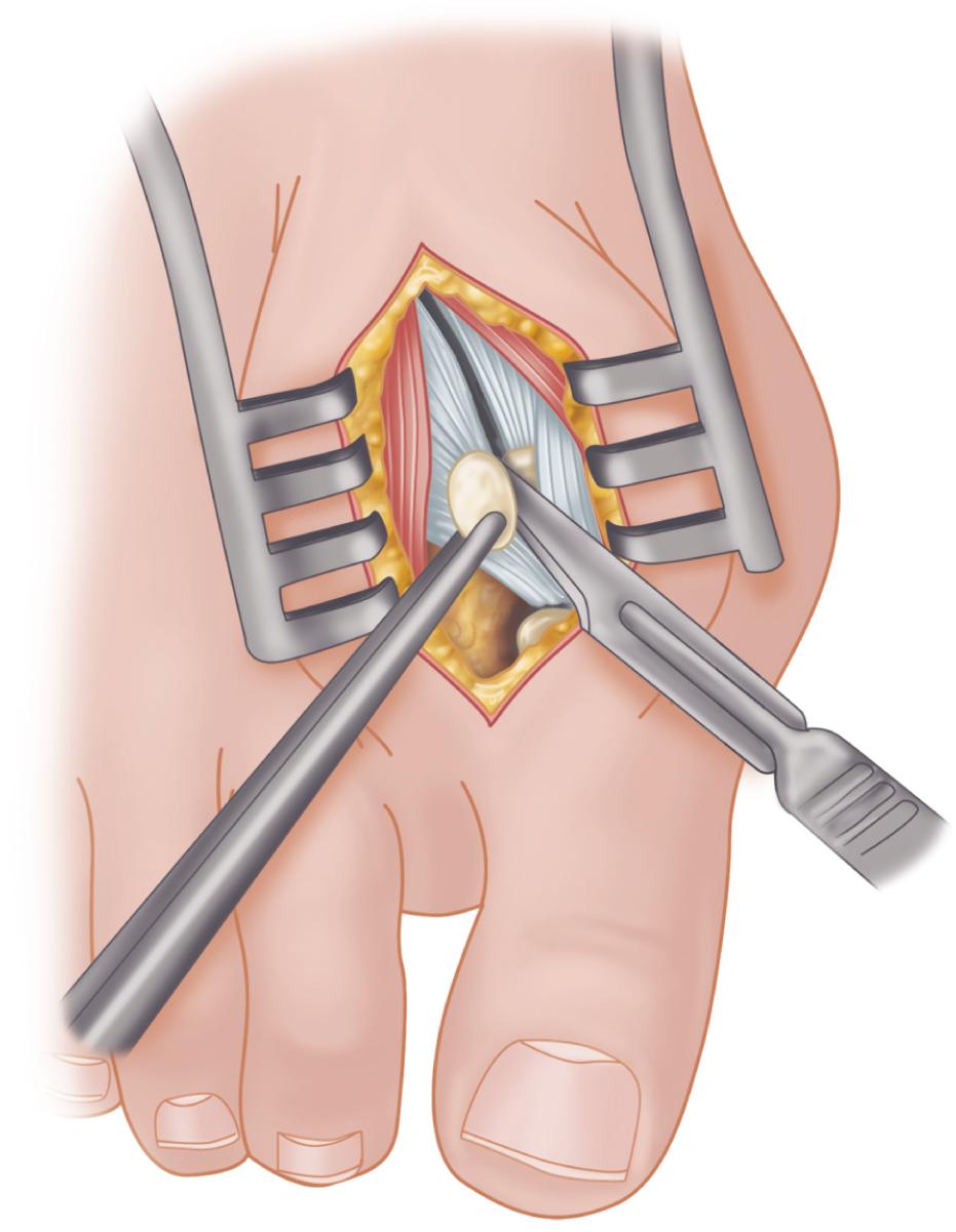 FIGURE 82.20, Modified McBride procedure. Fibular sesamoid is removed. SEE TECHNIQUE 82.1.