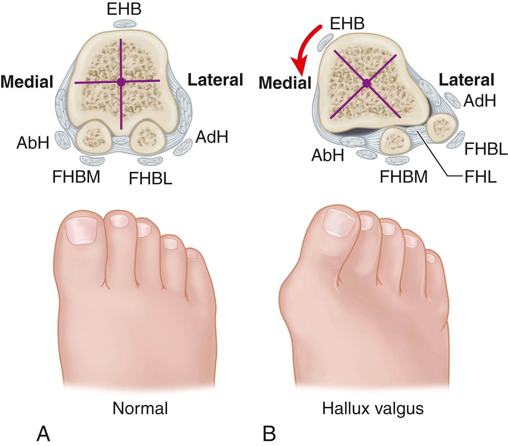 FIGURE 82.2, Pronation of hallux. A, Normal. B, Note plantar shift of abductor hallucis and lateral shift of sesamoids with associated intrinsic muscles of hallux. AbH , Abductor hallucis; AdH , adductor hallucis; EHB , extensor hallucis brevis; FHBL , flexor hallucis brevis lateral; FHBM , flexor hallucis brevis medial.