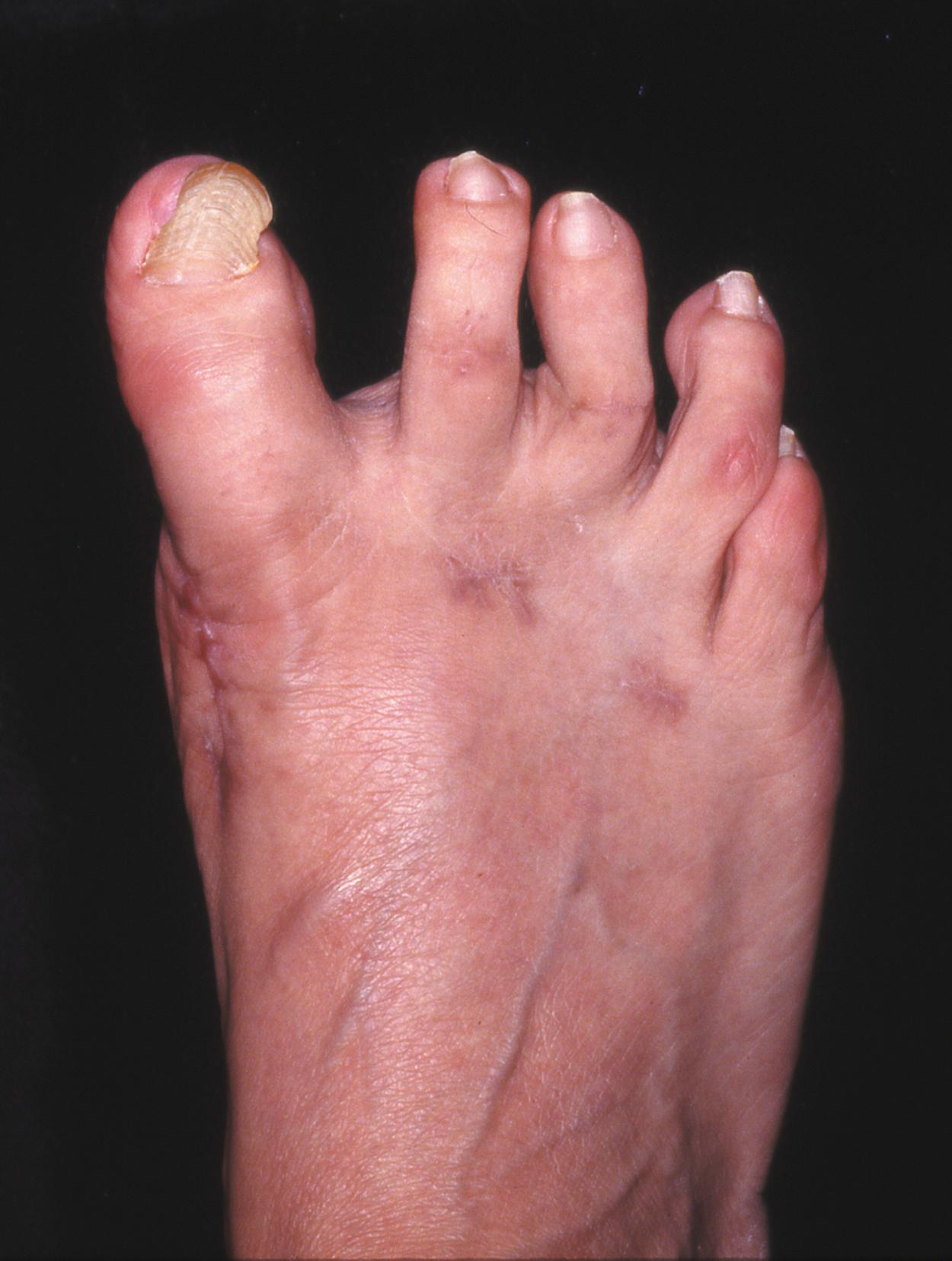 FIGURE 82.22, Hallux varus deformity after McBride bunionectomy and fibular sesamoidectomy through plantar incision. SEE TECHNIQUE 82.1.