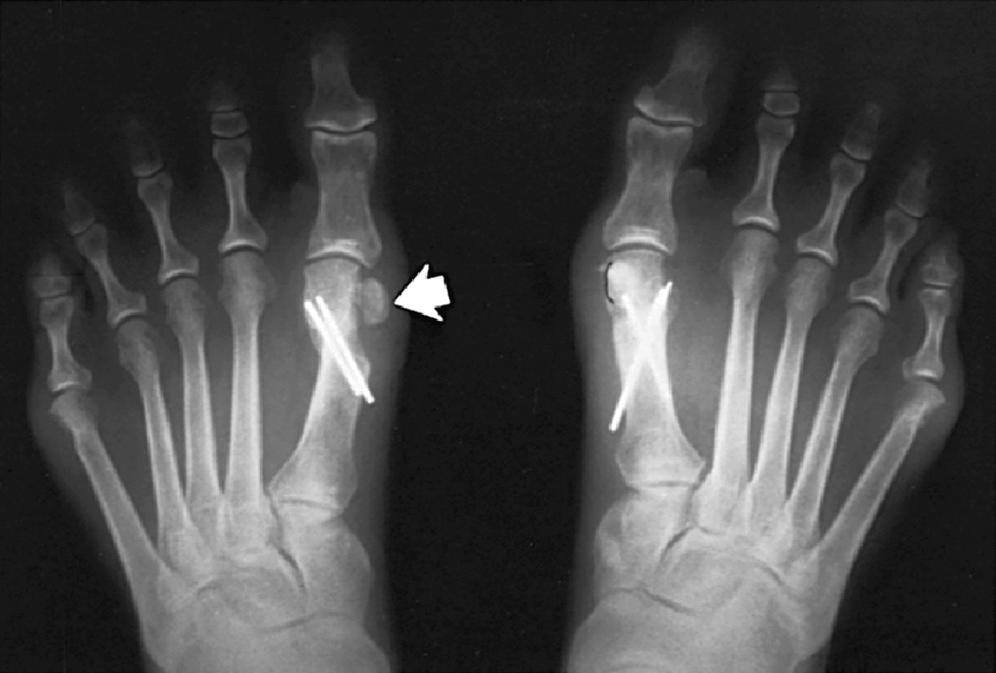 FIGURE 82.23, Dislocation of tibial sesamoid caused by overtightening of medial capsule and too much lateral shift of capital fragment (left) . Right foot has correct sesamoid position. SEE TECHNIQUE 82.1.