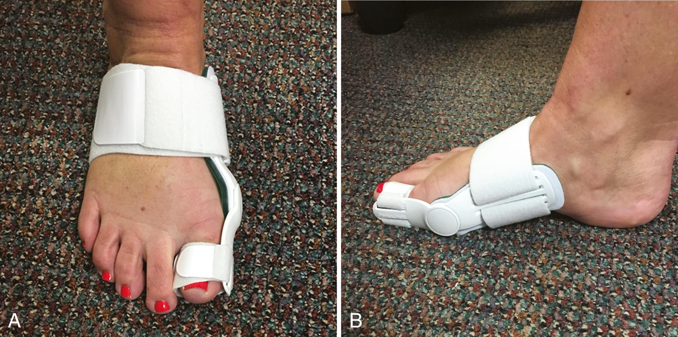 FIGURE 82.25, A and B, Hallux valgus night splint to be worn for 6 to 8 weeks after dressing changes are completed.