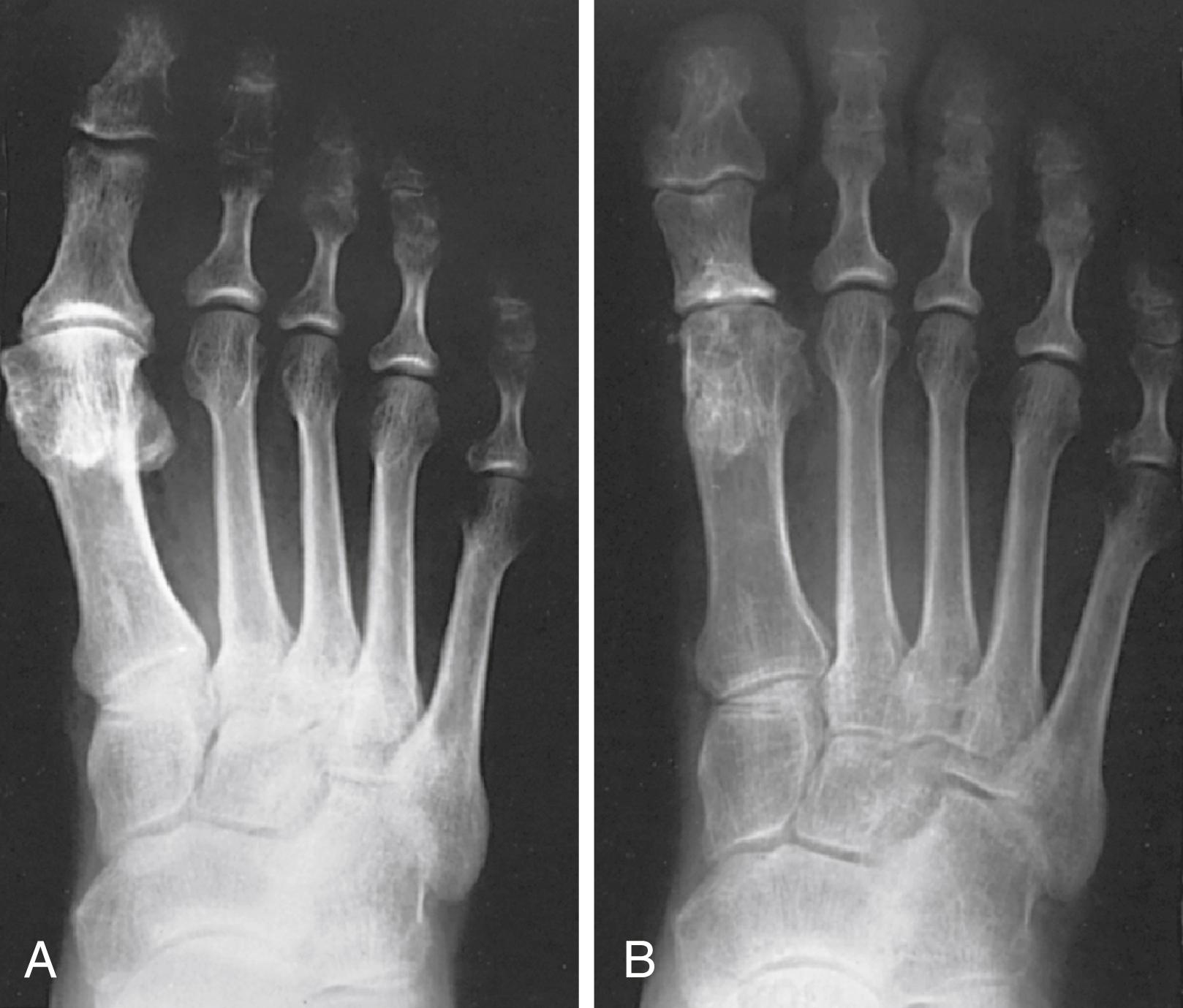 FIGURE 82.26, A, Anteroposterior radiograph of right foot of 65-year-old patient shows mild-to-moderate deformity and mild degenerative changes at first metatarsophalangeal joint; patient had intraarticular and periarticular symptoms. B, Twelve years after Keller procedure with excision of fibular sesamoid; note correction of first metatarsal varus and maintenance of enough joint space to allow functional range of motion.