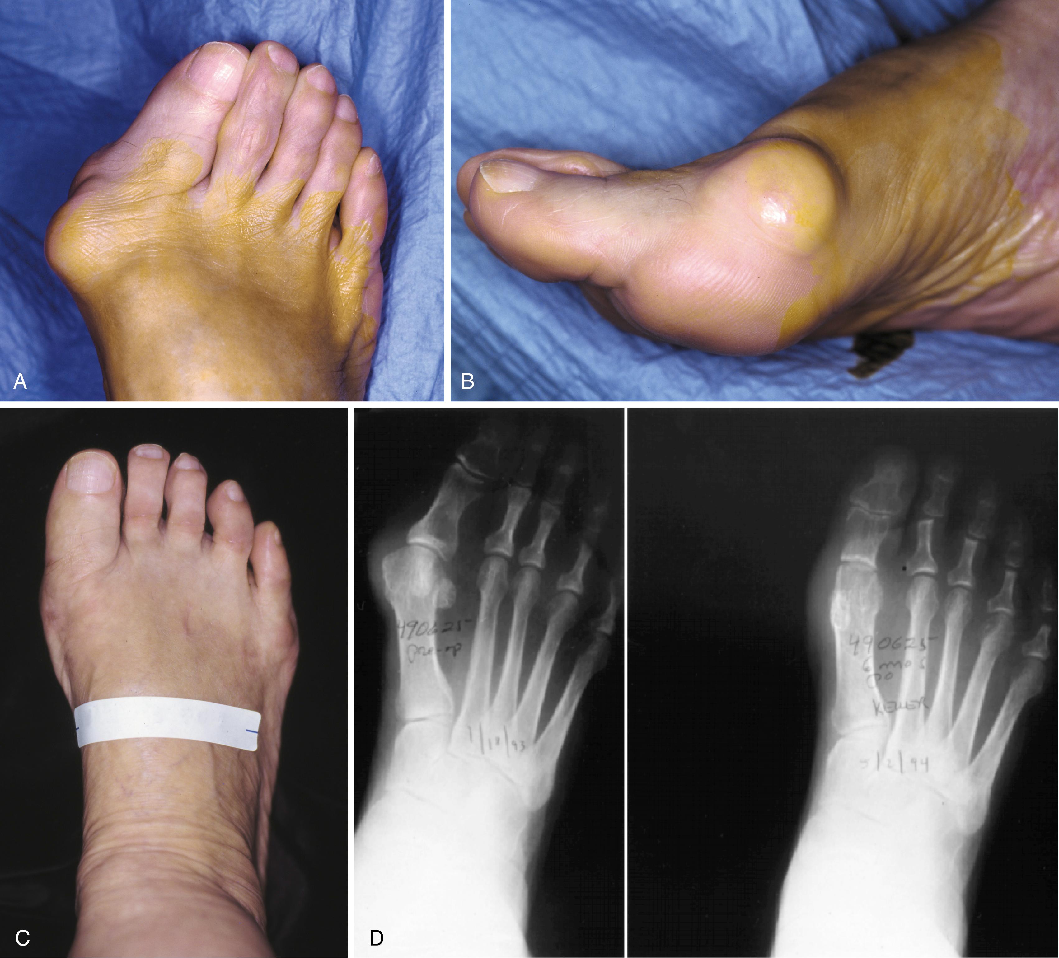 FIGURE 82.27, Severe hallux valgus with bursa formation in 70-year-old woman. A and B, Anteroposterior and lateral clinical photographs of patient’s right foot. C, Correction of deformity by modified Keller procedure. D, Preoperative and postoperative weight-bearing radiographs of same patient.