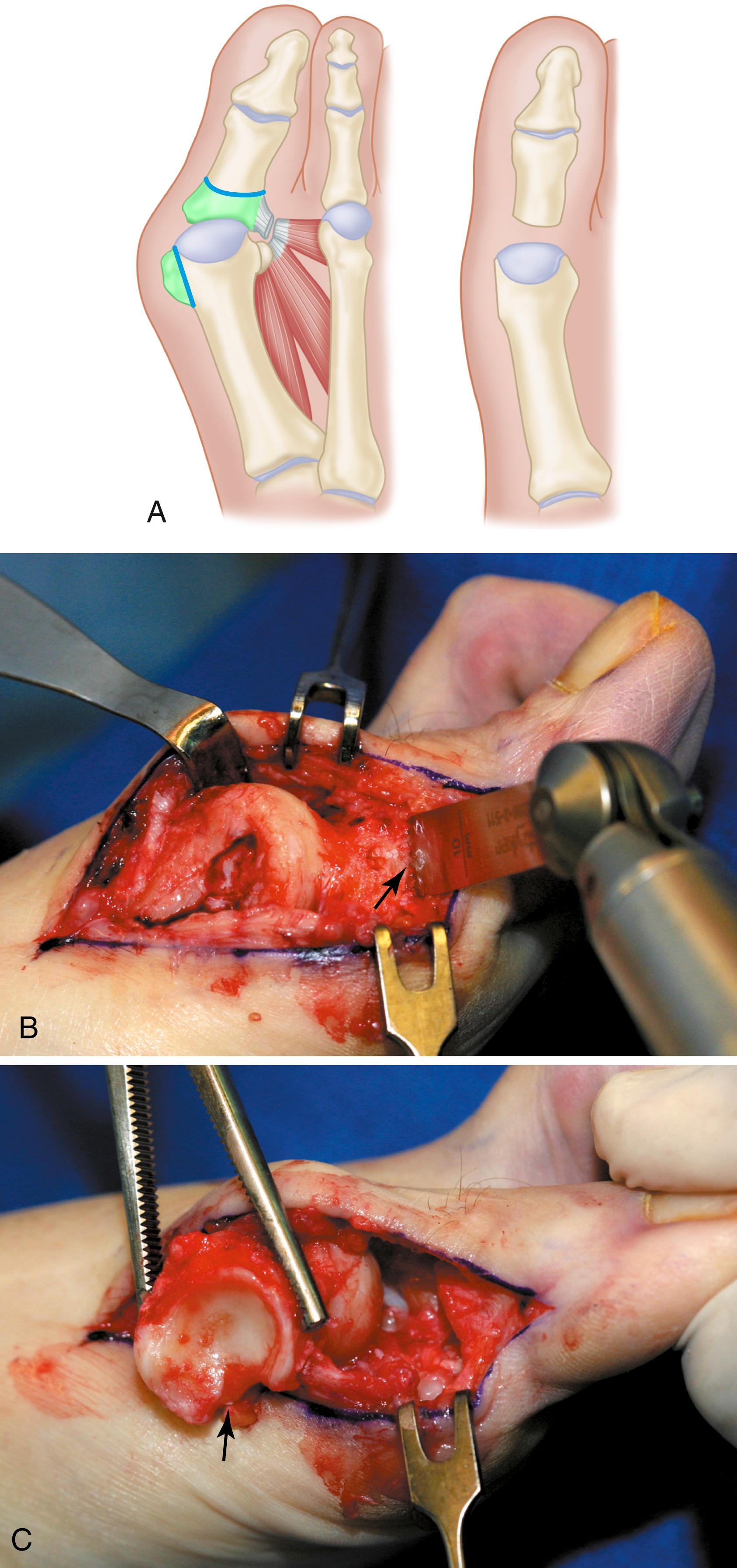 FIGURE 82.28, Keller technique. A, Resection of proximal phalanx, release of adductor tendon, and resection of medial eminence. B, Metaphyseal-diaphyseal junction of proximal phalanx (arrow) . C, Note concave plantar aspect of proximal phalanx for course of flexor hallucis longus tendon (arrow) . SEE TECHNIQUE 82-2.