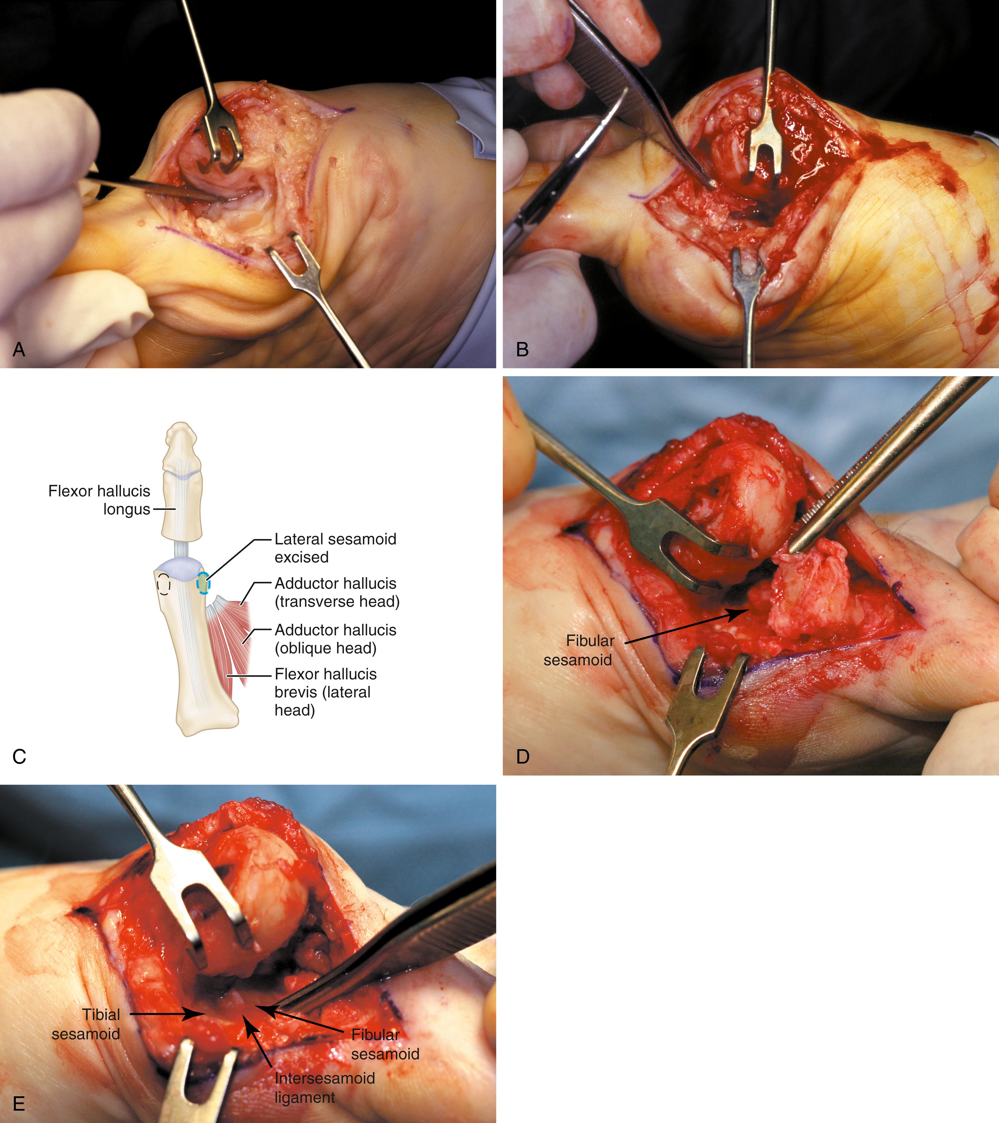 FIGURE 82.29, Excision of fibular sesamoid in modified Keller procedure. With base of proximal phalanx removed and medial eminence excision, exposure of fibular sesamoid is not as difficult from medial incision. A, Operative photograph showing elevation of first metatarsal with strong two-tooth retractor and use of small osteotome to mobilize fibular sesamoid and lateral capsuloligamentous (frequently contracted) structures. Osteotome is between metatarsal head and lateral sesamoid. When mobilization of fibular sesamoid is complete, entire sesamoid is visible for excision. Note chondromalacia of tibial sesamoid articular surface medial to osteotome. B, Fibular sesamoid has been excised, and lateral capsular structures and conjoined tendon (in forceps) have been released. Neurovascular bundle to lateral side of hallux is adjacent to these structures. C, Diagrammatic representation of modified Keller procedure. By excising fibular sesamoid, valgus moment of conjoined tendon of flexor hallucis brevis and adductor hallucis no longer pulls flexor hallucis longus tendon laterally (carrying hallux with it) through capsulosesamoid plantar plate and pulley system. D, Metatarsal head must be lifted dorsally to excise fibular sesamoid under direct vision. E, Note exposure of fibular sesamoid after mobilization of metatarsal head. F, Two 0.062-inch Kirschner wires are drilled distally. G, First metatarsal head is manually displaced laterally, and hallux is placed end-on the first metatarsal. Kirschner wires are drilled proximally across joint. H, Capsule is mobilized dorsally and plantarward. I, 2-0 or 3-0 absorbable sutures placed in purse-string fashion are used for capsular closure. J, Capsule must be closed over joint. Note pins cut off at skin level; they also can be bent at skin level. SEE TECHNIQUE 82.2.