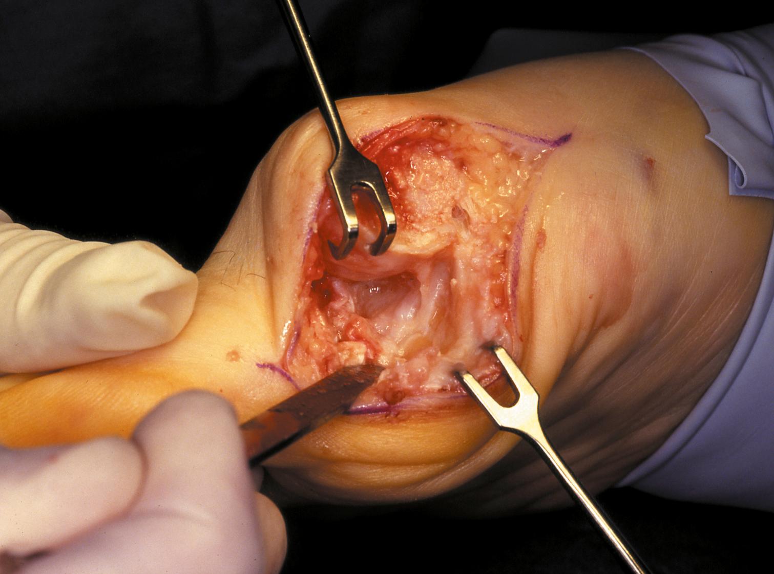 FIGURE 82.30, Firm fibrous band connects fibular sesamoid to base of proximal phalanx. Traction on band pulled hallux into valgus. Removing fibular sesamoid and holding hallux straight for 4 weeks improved results. SEE TECHNIQUE 82.2.