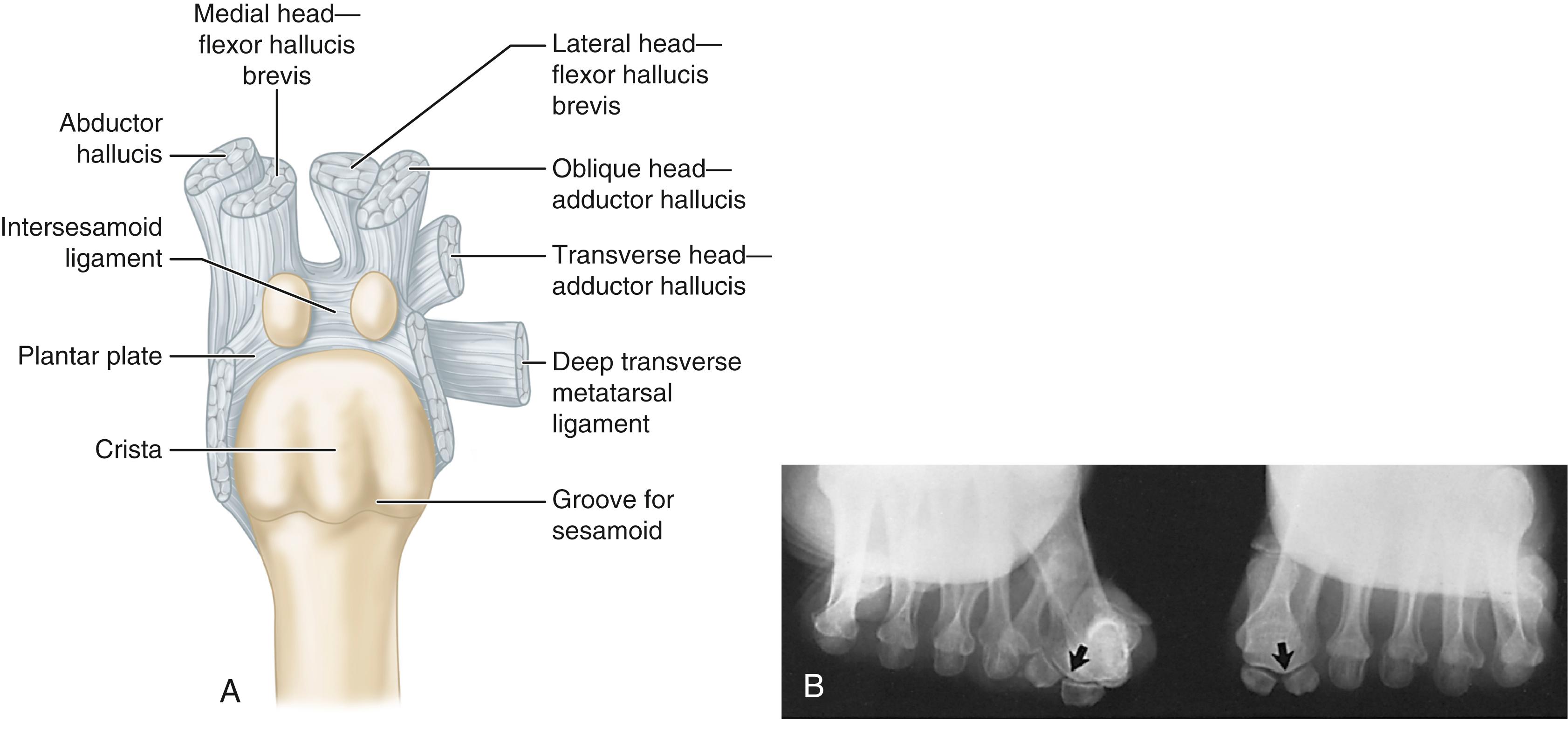 FIGURE 82.3, A, Plantar surface of first metatarsal head. Entire sesamoid sling with attached intrinsic musculature has been rotated distally off metatarsal head to present schematically relationships of muscle, tendon, capsule, ligaments, and articular configuration of first metatarsophalangeal joint. B, As metatarsal head moves medially, sesamoid sling apparatus becomes valgus deforming force, and metatarsal rotates (pronates) on its longitudinal axis. Intrinsic and extrinsic muscle balance is lost, and deformity increases. ( A after Beverly Kessler; courtesy LTI Medica and The Upjohn Company.)