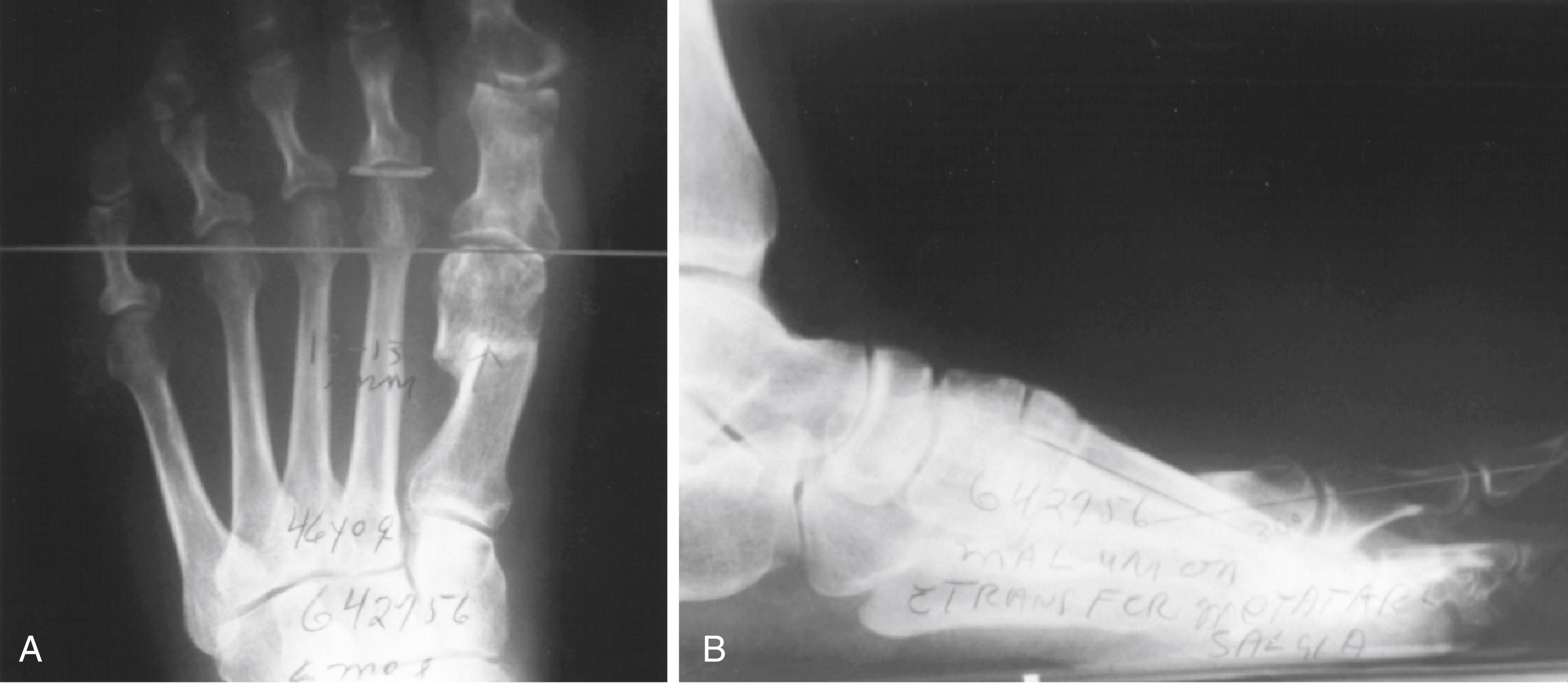 FIGURE 82.31, A and B, Anteroposterior and lateral weight-bearing radiographs of Mitchell procedure that, through excessive shortening and dorsally angulated malunion, has resulted in transfer metatarsalgia. This biplanar deformity is most difficult to correct.