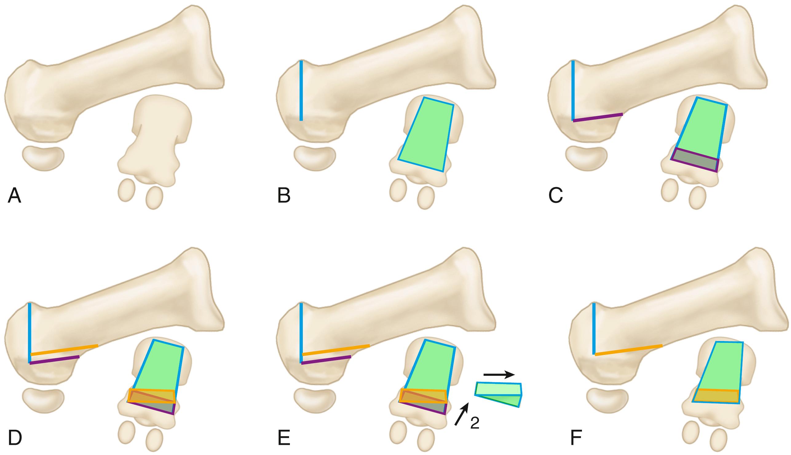 FIGURE 82.32, Rotational biplanar chevron osteotomy. A, Lateral and axial view of first metatarsal. B, Dorsal cut. C, First plantar cut. D, Second plantar cut. E, Removal of wedge. F, Rotation of fragments and correction of pronation.