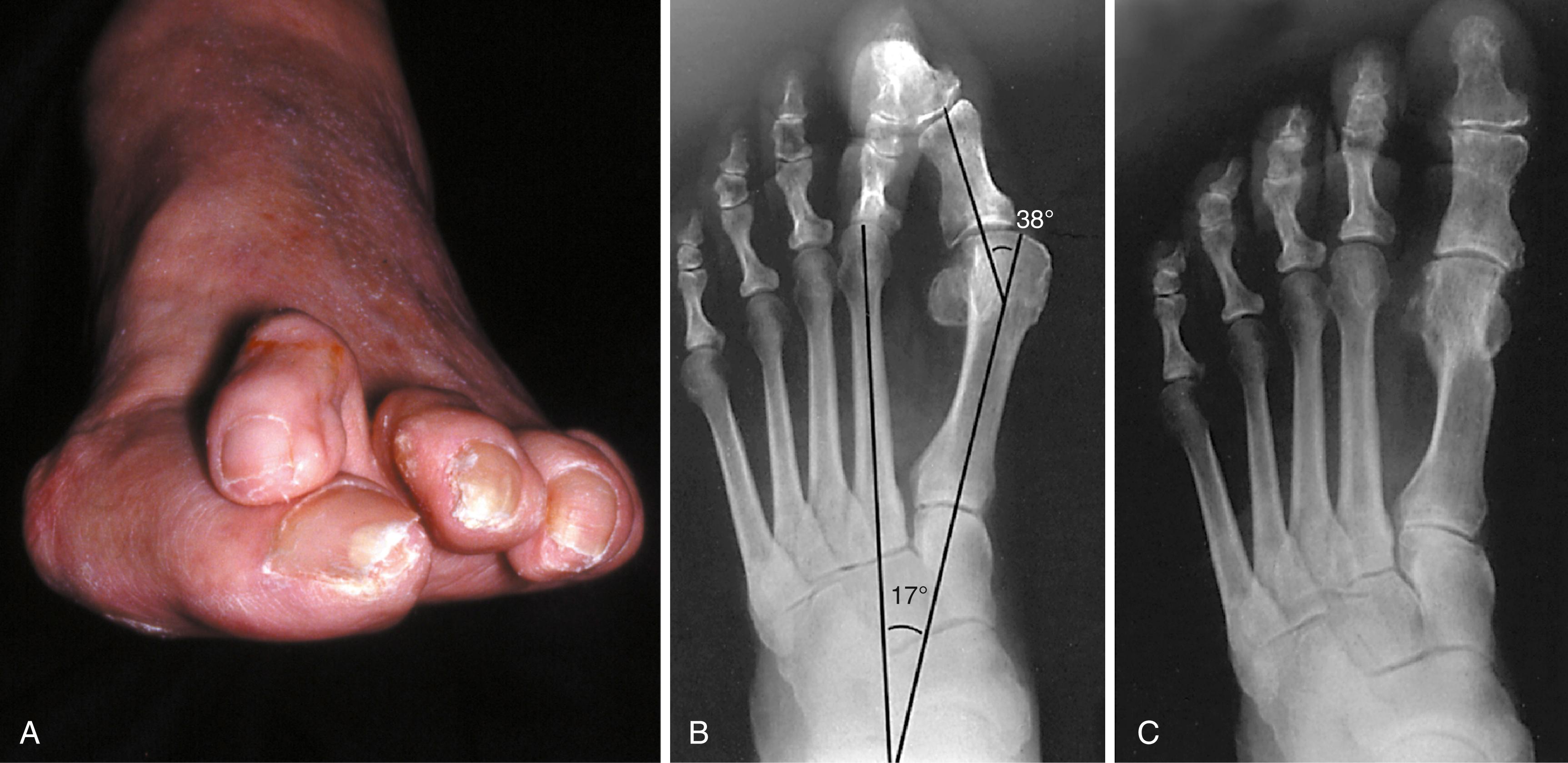 FIGURE 82.33, A, This degree of deformity (left foot) is difficult to correct with standard chevron osteotomy when apex is at subchondral bone of capital fragment. B, Standing radiograph of left foot before correction. C, Standing radiograph 1 year after chevron osteotomy, release of adductor hallucis, Akin osteotomy, and correction of hammer toe.