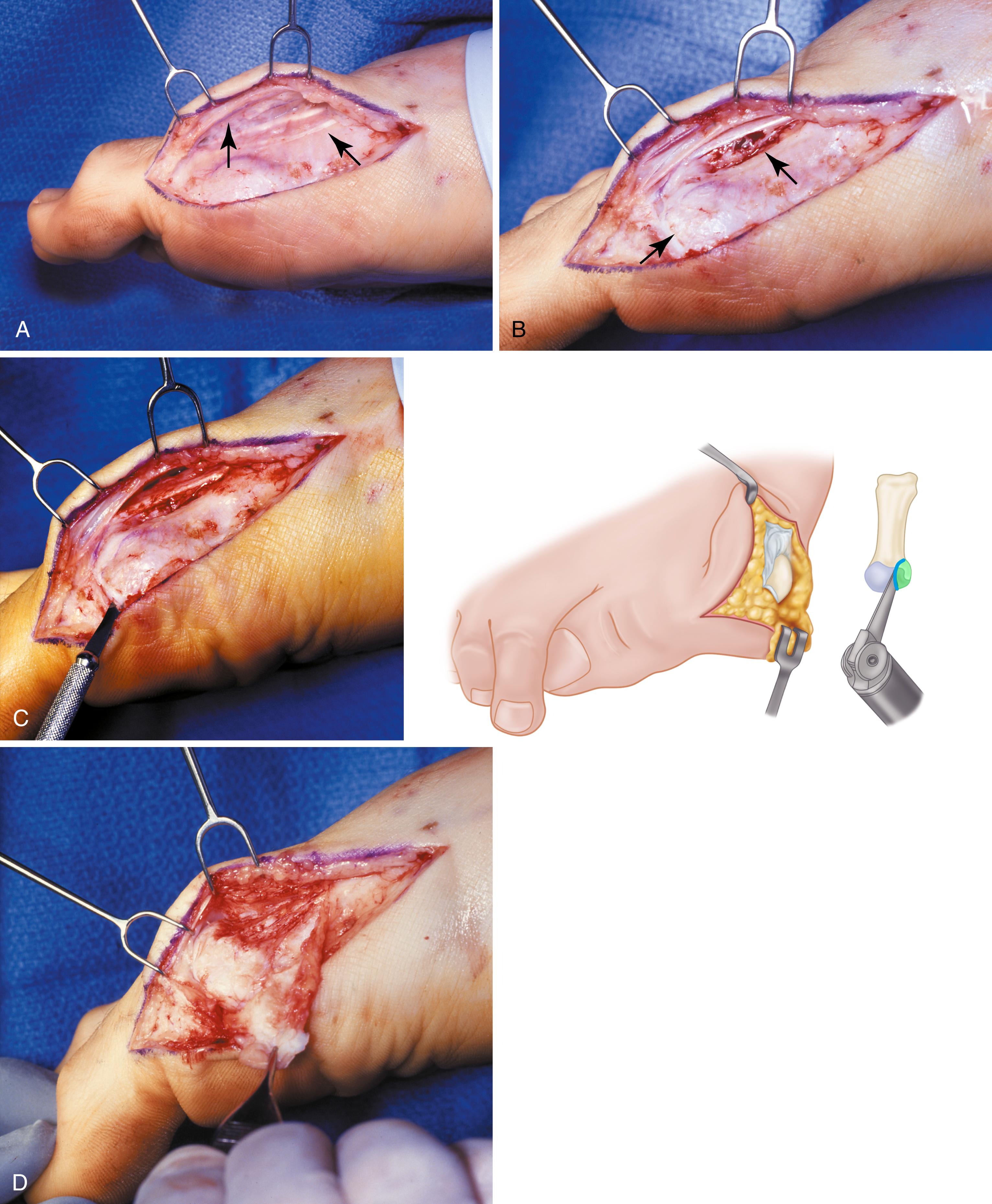 FIGURE 82.35, Modified chevron distal metatarsal osteotomy. A, Sensory branch of superficial peroneal nerve (left arrow) and accessory extensor hallucis longus (right arrow) . B, Inverted L-shaped capsulotomy. C, Transverse limb of L-capsulotomy. D, Reflection of capsule. E, Apex of osteotomy is 1 to 1.3 cm proximal to articular surface, depending on size of metatarsal head. F, Dorsal limb of osteotomy and width of saw blade. G, Completion of osteotomy. H, Lateral translation of capital fragment. Note overhang of proximal metatarsal (arrow) . I and J, Kirschner wire in place (top arrow) ; resection of overhang of proximal metatarsal (bottom arrow) . K, Completed osteotomy. L, Hallux is placed in corrected position while dressing is applied. M, Absorbable pins that can be trimmed may be used as alternative. SEE Technique 82.4.