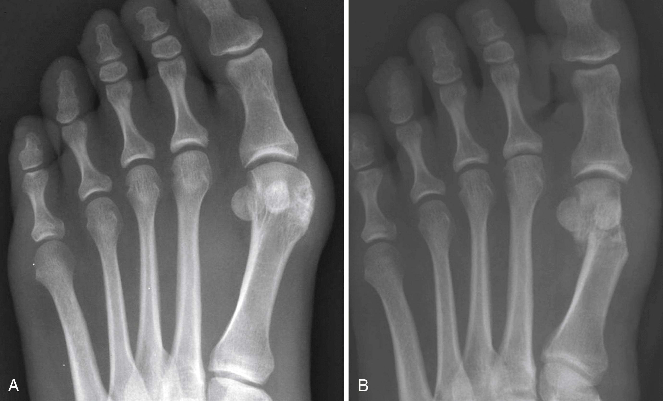 FIGURE 82.34, A, Preoperative hallux varus deformity. B, Postoperative radiograph .