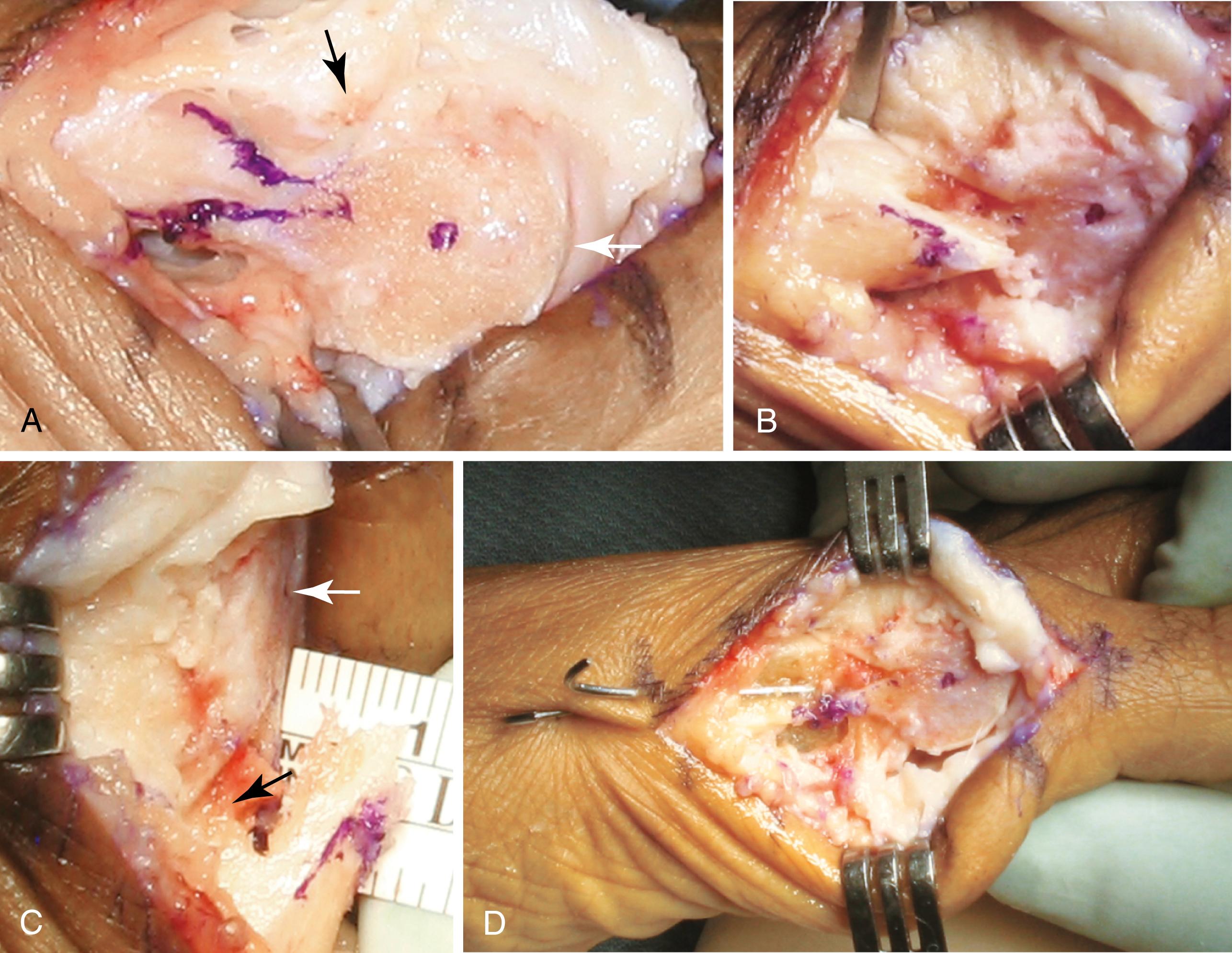 FIGURE 82.36, Increased displacement distal chevron osteotomy. A , Exposure and marking for osteotomy cuts. B , Sagittal view showing lateral translation of distal fragment. C , Dorsal view showing lateral translation of approximately 9 mm. White arrow points to the mark on center of metatarsal head; black arrow denotes lateral spike on which head fragment is perched. D , After placement of Kirschner wires and resection of residual medial bone flush with metatarsal head. (From Murawski DE, Beskin JL: Increased displacement maximizes the utility of the distal chevron osteotomy for hallux valgus deformity correction, Foot Ankle Int 29:156, 2008.) SEE TECHNIQUE 82.6 .