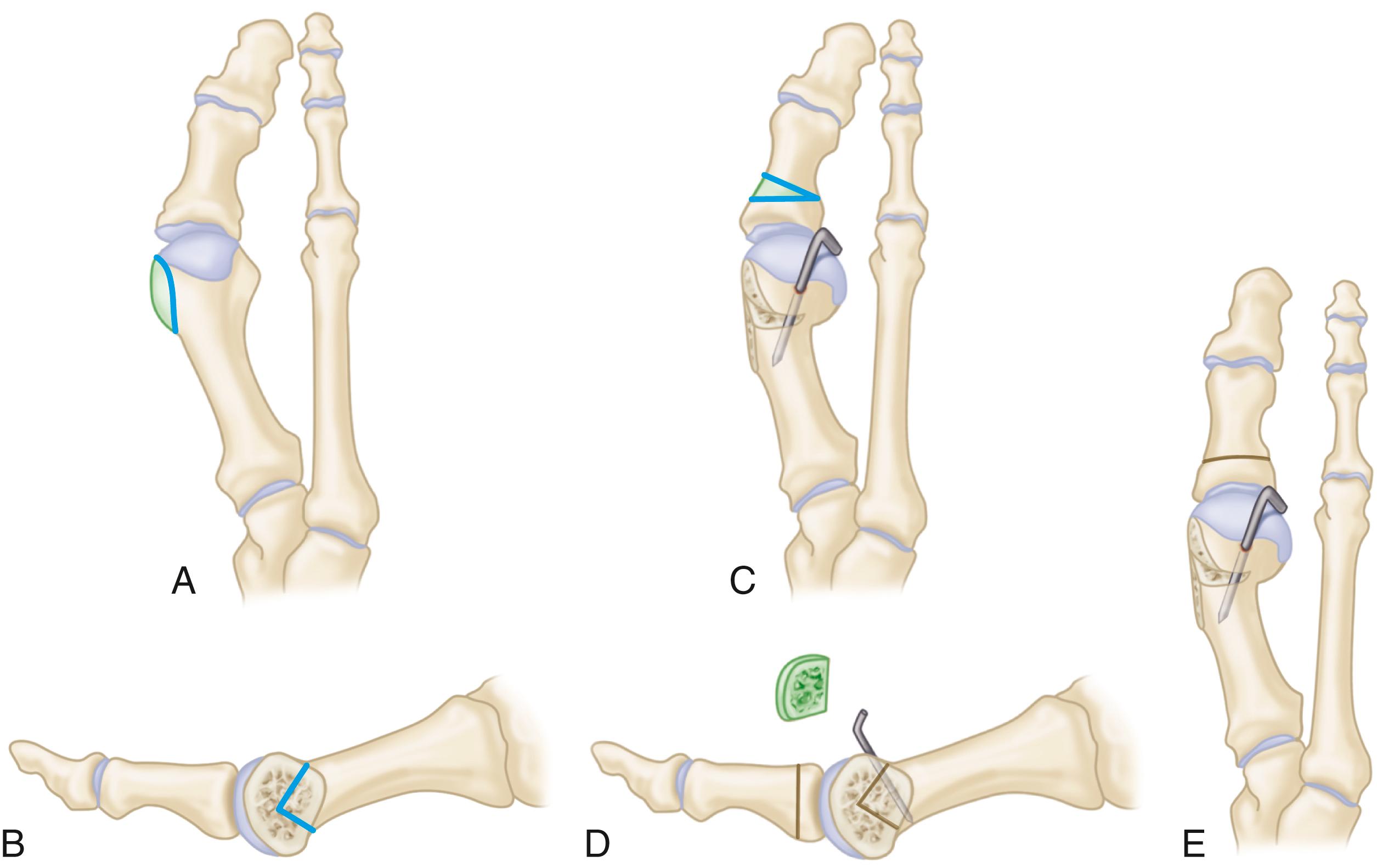 FIGURE 82.37, Chevron-Akin double osteotomy. A, Resection of medial eminence parallel to medial border of foot. B, Chevron osteotomy cut is made, and metatarsal head is shifted laterally 2.5 to 3.0 mm. C, Osteotomy is fixed with 0.045-inch smooth pin, and protruding medial border of metatarsal is osteotomized flush with metatarsal head. D, Akin cut parallels concavity at base of proximal phalanx, and 1-mm wedge of bone is removed. E, Suture closure of Akin osteotomy corrects residual valgus of hallux. (From Mitchell LA, Baxter DE: A chevron-Akin double osteotomy for correction of hallux valgus, Foot Ankle 12:7, 1991.) SEE TECHNIQUE 82.7 .