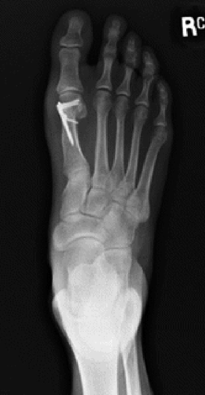 FIGURE 82.38, Chevron bunionectomy using Tornier Mini Maxlock extreme ISO plate system. (From Bennett GL, Sabetta JA: Evaluation of an innovative fixation system for chevron bunionectomy, Foot Ankle Int 37:205, 2016.) SEE TECHNIQUE 82.8 .