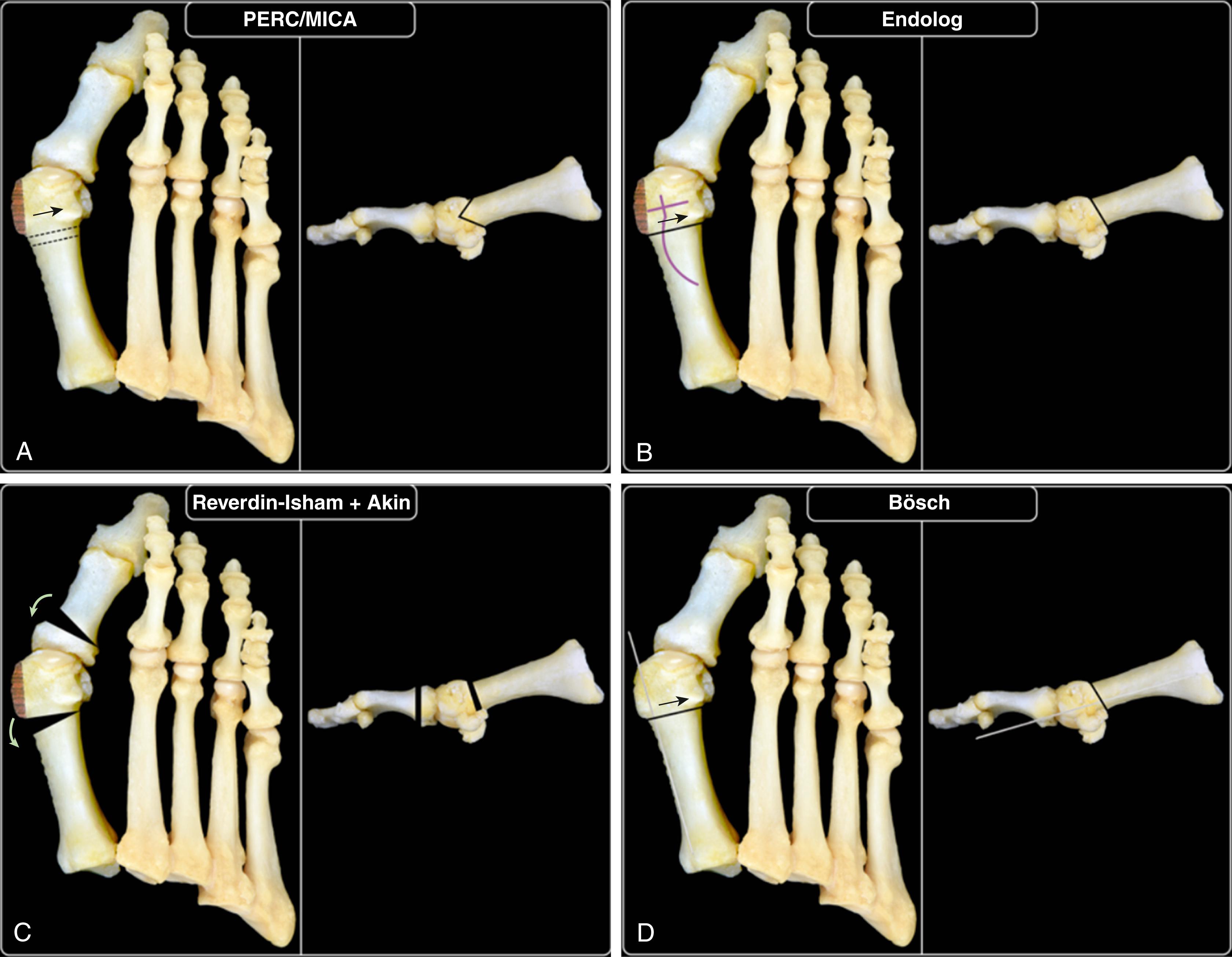 FIGURE 82.39, A, Minimally invasive chevron-Akin osteotomy and percutaneous extraarticular reverse-L chevron osteotomy. B, Endolog osteotomy technique. C, Reverdin-Isham technique. D, Bösch technique. (From Malagelada F, Sahirad C, Dalmau-Pastor M, et al: Minimally invasive surgery for hallux valgus: a systematic review of current surgical techniques, Int Orthop 43:625, 2019.)