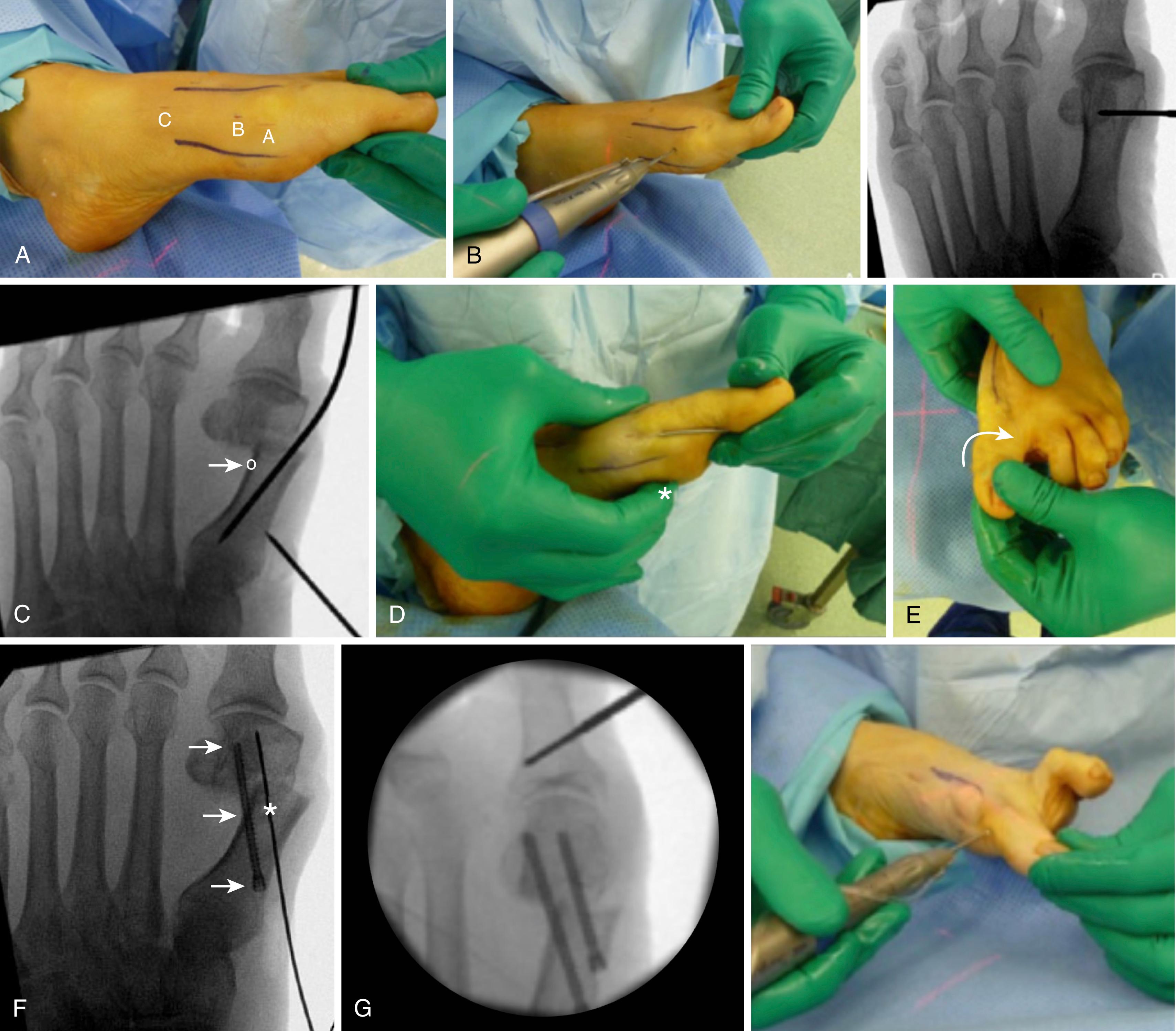 FIGURE 82.40, Minimally invasive chevron-Akin osteotomy. A, Initial stab incisions . B, Dorsal and plantar cuts of chevron osteotomy using a Shannon burr. C, Varus force applied with 2-mm Kirschner wire from translation of distal fragment (arrow shows targeted far cortex for initial guide pin, which enables three-point screw fixation). D, Clinical photo. Index finger supports metatarsal head to maintain alignment ( asterisk ). E, Correction maneuver for pronation. Supination force is applied as demonstrated by arrow. F, Three - point fixation of first proximal screw ( arrows ) and guide pin for second screw ( asterisk ). G, Initial placement of Shannon burr for apex of Akin osteotomy. H, Placement of screw after Akin osteotomy. I, For distal soft-tissue procedure, beaver blade is introduced from dorsum of first metatarsophalangeal joint lateral to extensor hallucis longus tendon. J, As varus force is applied to great toe, blade divides lateral plantar plate and lateral sesamoid phalangeal ligament. (From Lee M, Walsh J, Smith MM et al: Hallux valgus correction comparing percutaneous chevron/Akin (PECA) and open scarf/Akin osteotomies, Foot Ankle Int 38:838, 2017.) SEE TECHNIQUE 82.9 .