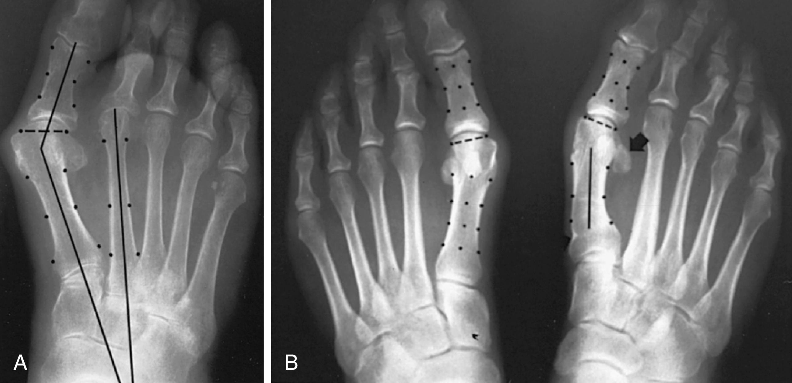 FIGURE 82.4, A, Note valgus orientation of articular surface of first metatarsal head. B, After proximal metatarsal osteotomy on right foot. Sesamoid sling remains dislocated, articular surface of metatarsal head maintains valgus posture, and joint is congruous in valgus. Double osteotomy of first metatarsal (proximally for varus correction and distally for valgus correction of articular surface) and soft-tissue realignment are necessary. Alternatively, arthrodesis of first metatarsophalangeal joint or distal metatarsal osteotomy (chevron) can be performed. Without anatomic reduction of sesamoid sling apparatus, distal metatarsal osteotomy would fail.