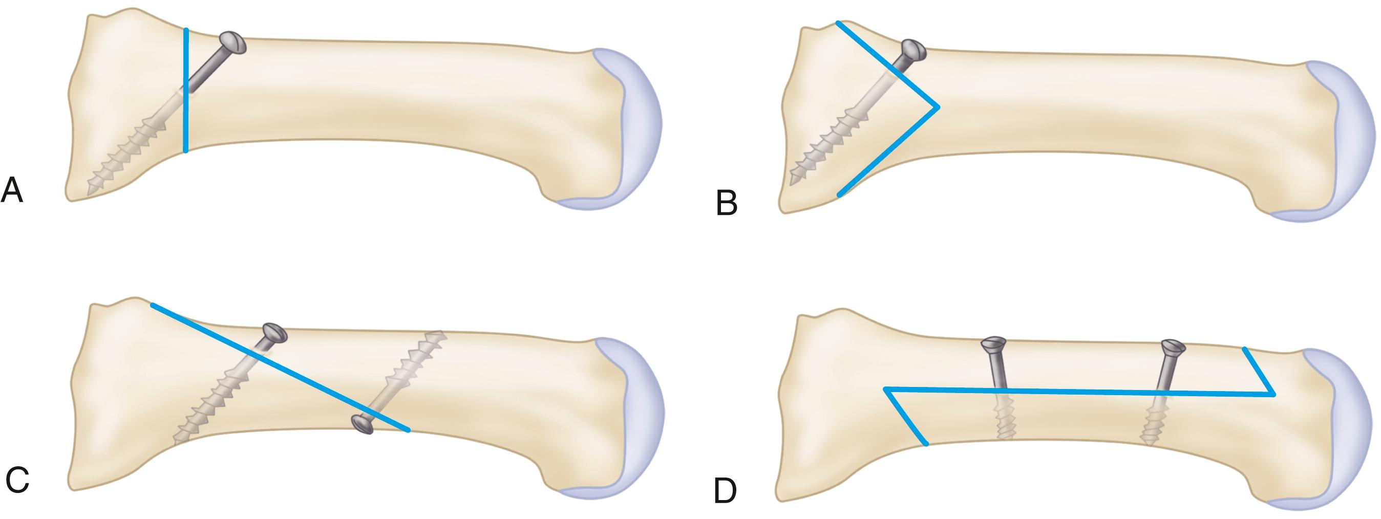 FIGURE 82.41, Four commonly used metatarsal shaft osteotomies. A, Proximal crescentic osteotomy. B, Proximal chevron osteotomy. C, Ludloff osteotomy. D, Scarf osteotomy.