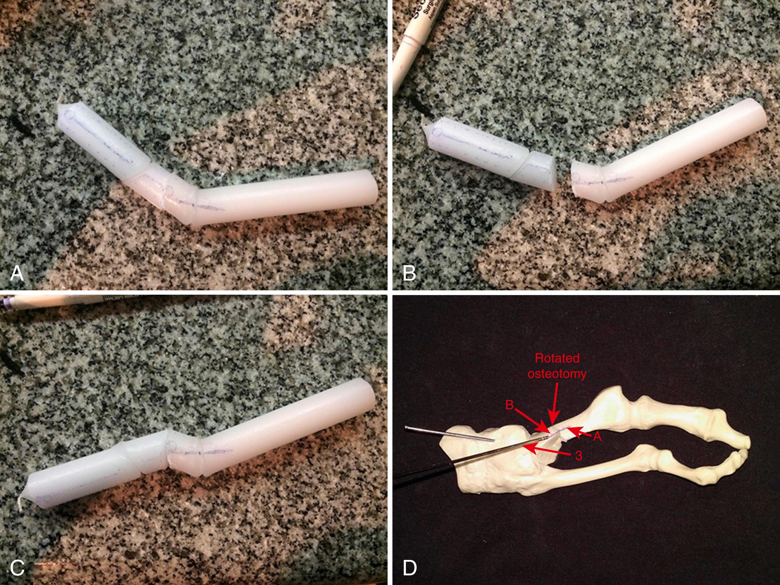 FIGURE 82.42, Rotational osteotomy for hallux valgus. A, Candlewax model showing deformity before osteotomy . B, Model showing osteotomy cut. C, Model after rotating the distal part. D, Bone model after correction through metatarsal external rotation. Note how lines A and B match on dorsum of metatarsal. 3, Kirschner wire, which is used for osteotomy fixation.