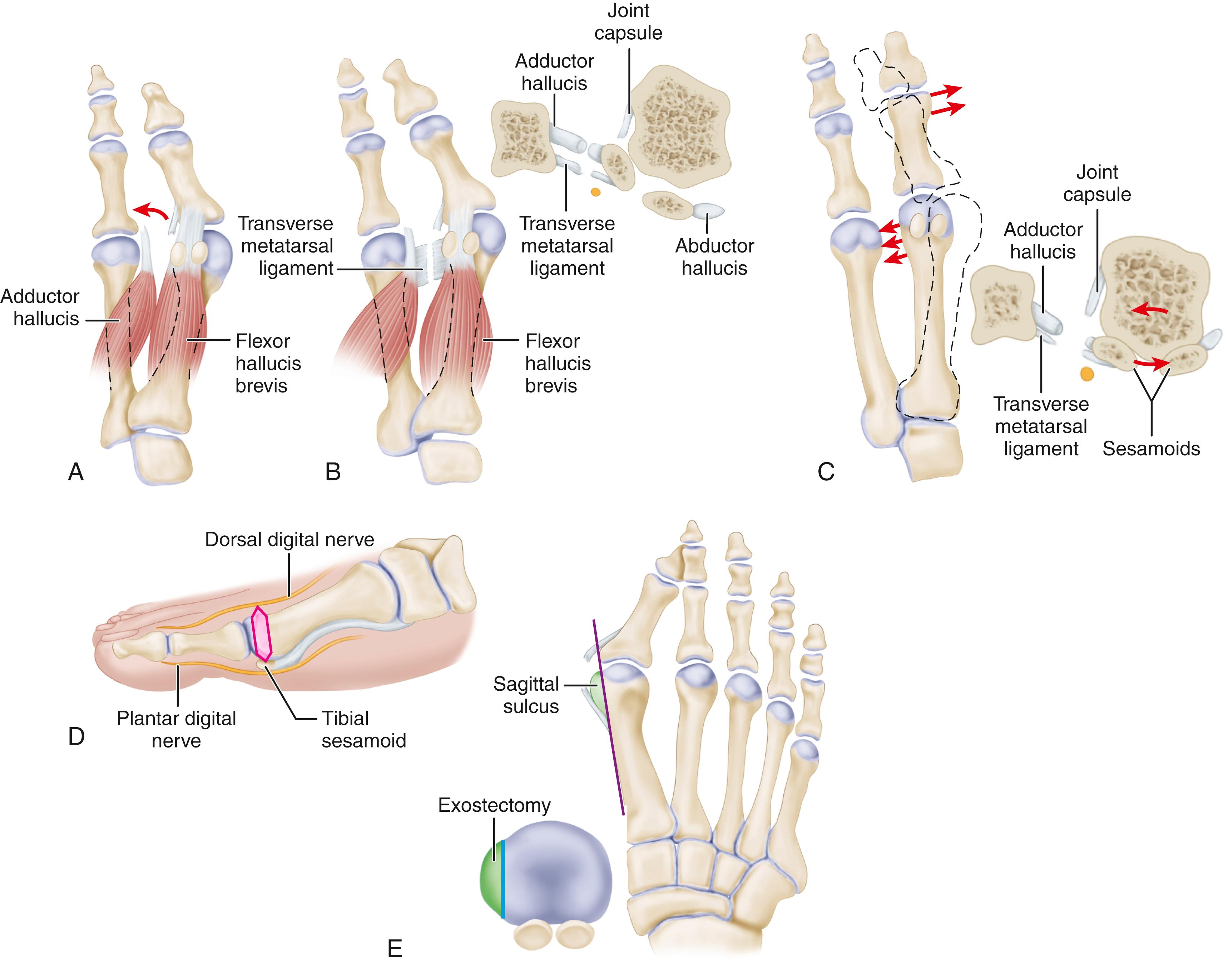 FIGURE 82.44, A, Adductor tendon released from insertion into lateral aspect of fibular sesamoid and base of proximal phalanx. B, Transverse metatarsal ligament has been transected. Inset shows that at this point, contracted lateral joint capsule, adductor hallucis, and transverse intermetatarsal ligament have been released. C, If metatarsal head springs back medially when pushed laterally, osteotomy should be considered. D, Medial capsular incision, beginning 2 to 3 mm proximal to base of proximal phalanx. Second incision is made 3 to 8 mm more proximal, removing flap of tissue. Size of flap is determined by severity of deformity. Wedge of tissue approximately 6 mm is removed. Capsular cut is V-shaped through abductor hallucis tendon with apex at tibial sesamoid. Medial eminence is exposed by making incision along dorsomedial aspect of capsule and peeling it off medial eminence with sharp dissection. E, Removal of medial eminence is done on line projected along medial aspect of the first metatarsal shaft, and exostectomy should be done 1 to 2 mm medial to sagittal sulcus. F, Knife blade is in metatarsocuneiform joint, and two lines marked on metatarsal represent osteotomy site (proximal line) and location of screw for fixation (distal line) . G, Final position of screw and position of metatarsal after correction of first metatarsal. H, Note Freer elevator is displacing or rotating proximal fragment medially whereas first metatarsal head and distal fragment are being angulated laterally by manual pressure. ( A-D from Mann RA, Coughlin MJ: The video textbook of foot and ankle surgery , St. Louis, 1991, Medical Video Productions; E from Mann RA, Coughlin MJ, editors: Surgery of the foot and ankle , ed 6, St. Louis, 1993, Mosby.) SEE TECHNIQUE 82.10.